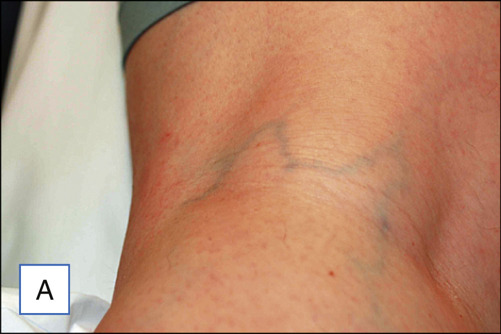 Five photo panels show injection into a leg vein followed by compression using a cotton ball and tape. The five photo panels are labeled A to E. Panel A shows a leg with visible surface veins. Panel B shows gloved hands applying two-point counter pressure around the injection site while holding a syringe. Panel C shows the needle entering the vein at an angle. Panel D shows the injection into the vein with blanching around the site. Panel E shows a cotton ball placed over the injection site and secured with tape.