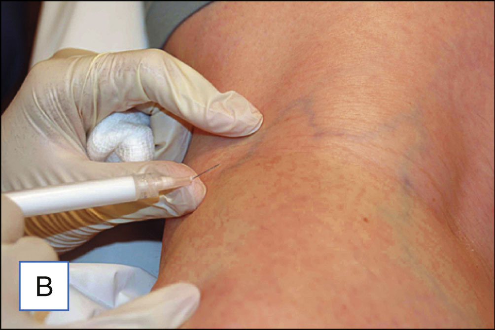 Five photo panels show injection into a leg vein followed by compression using a cotton ball and tape. The five photo panels are labeled A to E. Panel A shows a leg with visible surface veins. Panel B shows gloved hands applying two-point counter pressure around the injection site while holding a syringe. Panel C shows the needle entering the vein at an angle. Panel D shows the injection into the vein with blanching around the site. Panel E shows a cotton ball placed over the injection site and secured with tape.