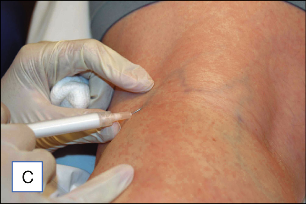 Five photo panels show injection into a leg vein followed by compression using a cotton ball and tape. The five photo panels are labeled A to E. Panel A shows a leg with visible surface veins. Panel B shows gloved hands applying two-point counter pressure around the injection site while holding a syringe. Panel C shows the needle entering the vein at an angle. Panel D shows the injection into the vein with blanching around the site. Panel E shows a cotton ball placed over the injection site and secured with tape.