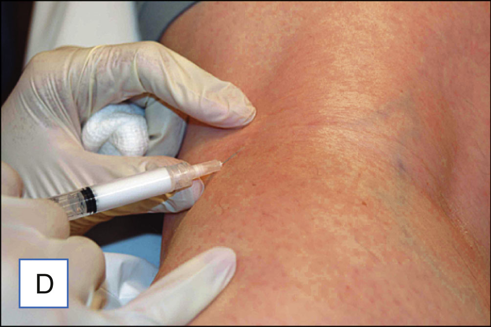Five photo panels show injection into a leg vein followed by compression using a cotton ball and tape. The five photo panels are labeled A to E. Panel A shows a leg with visible surface veins. Panel B shows gloved hands applying two-point counter pressure around the injection site while holding a syringe. Panel C shows the needle entering the vein at an angle. Panel D shows the injection into the vein with blanching around the site. Panel E shows a cotton ball placed over the injection site and secured with tape.
