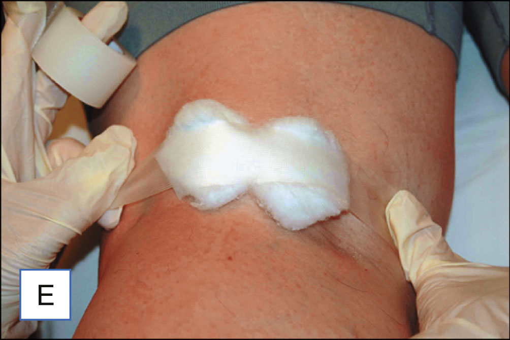 Five photo panels show injection into a leg vein followed by compression using a cotton ball and tape. The five photo panels are labeled A to E. Panel A shows a leg with visible surface veins. Panel B shows gloved hands applying two-point counter pressure around the injection site while holding a syringe. Panel C shows the needle entering the vein at an angle. Panel D shows the injection into the vein with blanching around the site. Panel E shows a cotton ball placed over the injection site and secured with tape.