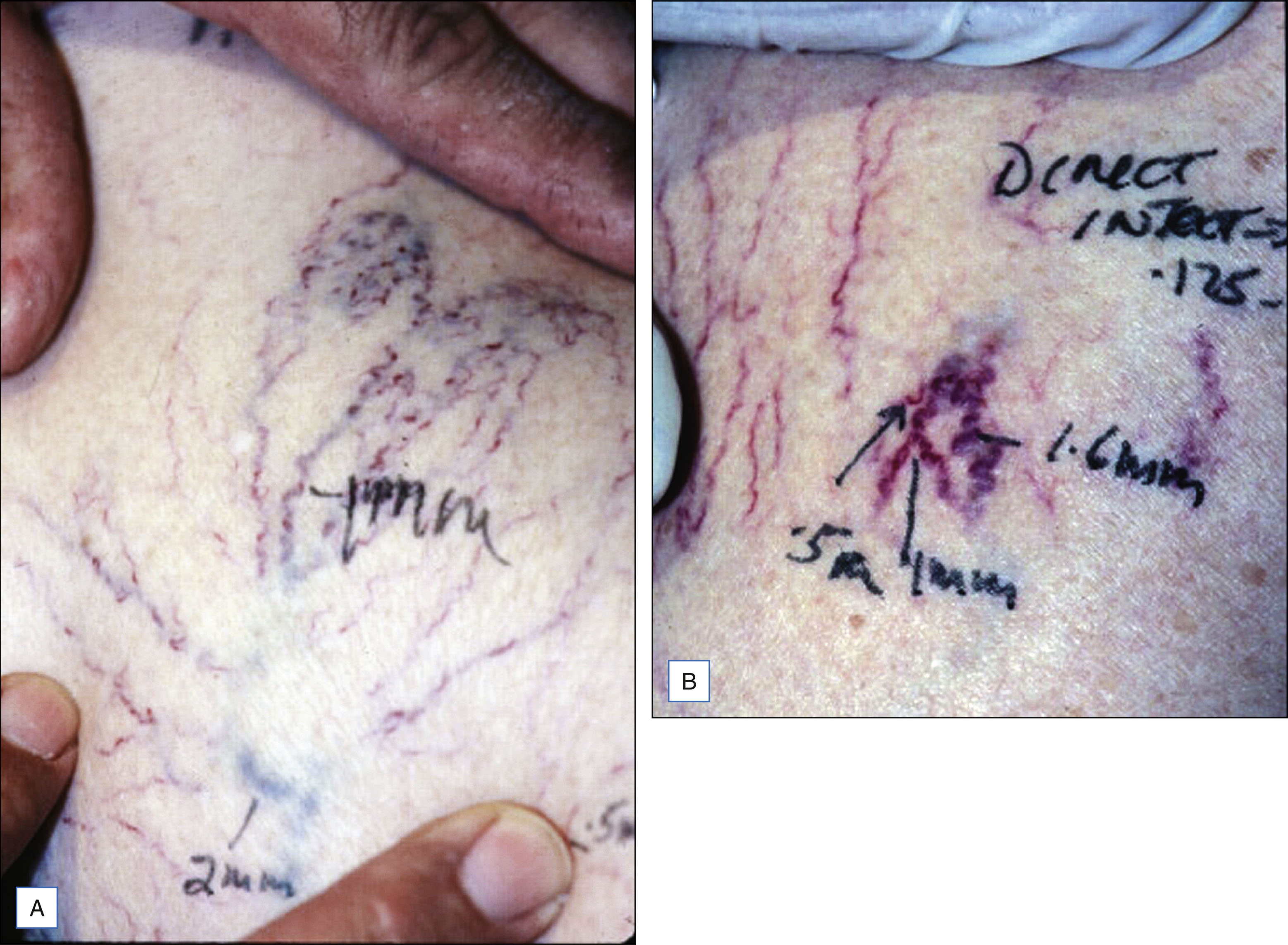 A two-panel photo sequence shows skin with drawn markings of vessel measurements, and labels show named vessels and sizes. The photo sequence has two panels. Panel A shows a close view of skin with vessel outlines marked and labeled with the names basilic and cephalic, along with size measurements in millimeters. Panel B shows a closer view of marked vessels labeled as deeper arteries and veins with size values in millimeters and named vessels, including radial and ulnar.