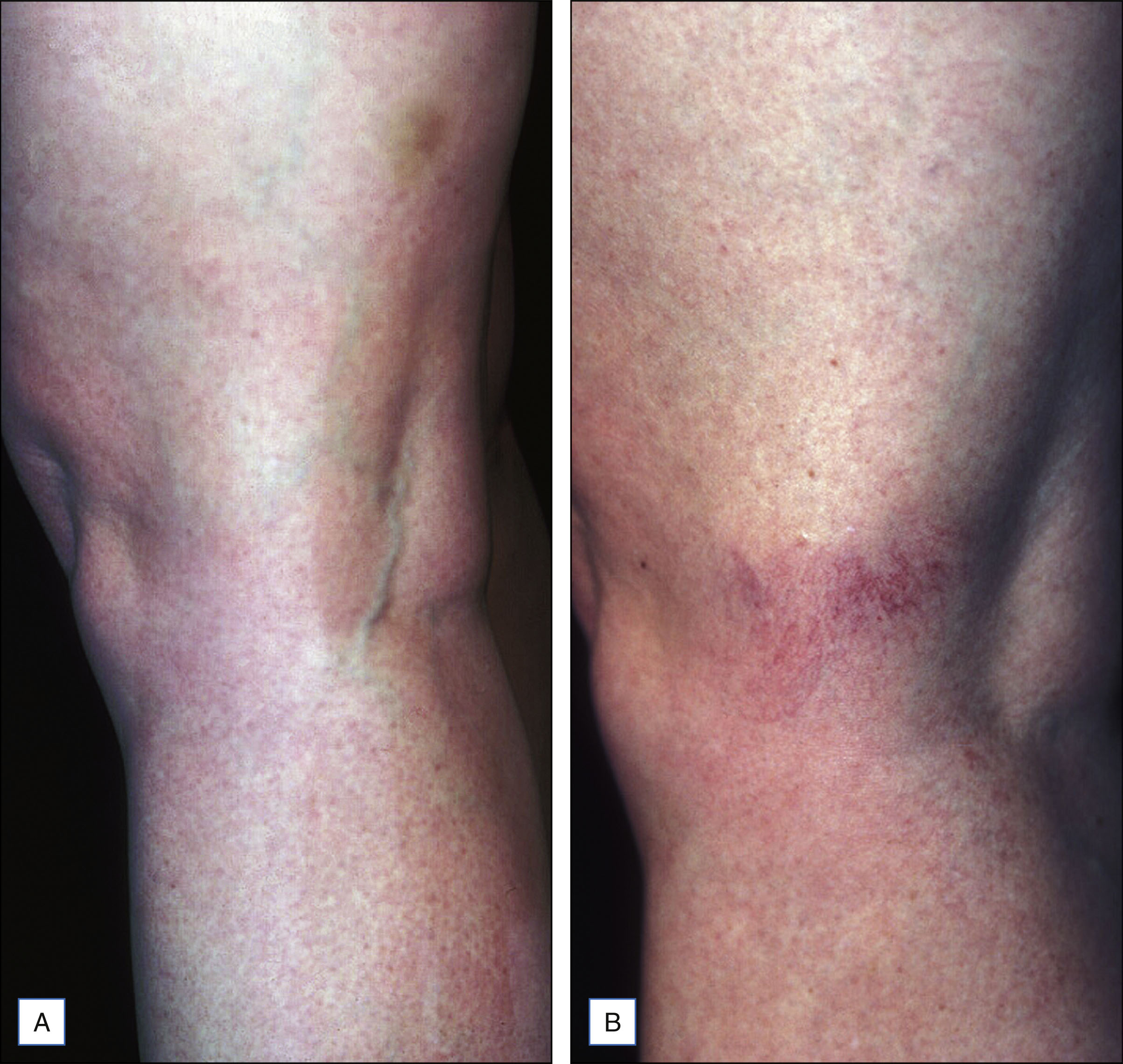 A two-panel photo sequence shows a close view of the back of the leg before and after treatment with visible changes in vein appearance. The photo sequence has two panels. Panel A shows a close view of the back of the leg with a small visible vein on the side of the knee. Panel B shows the same area after treatment with a denser network of fine superficial vessels spread over the treated area.