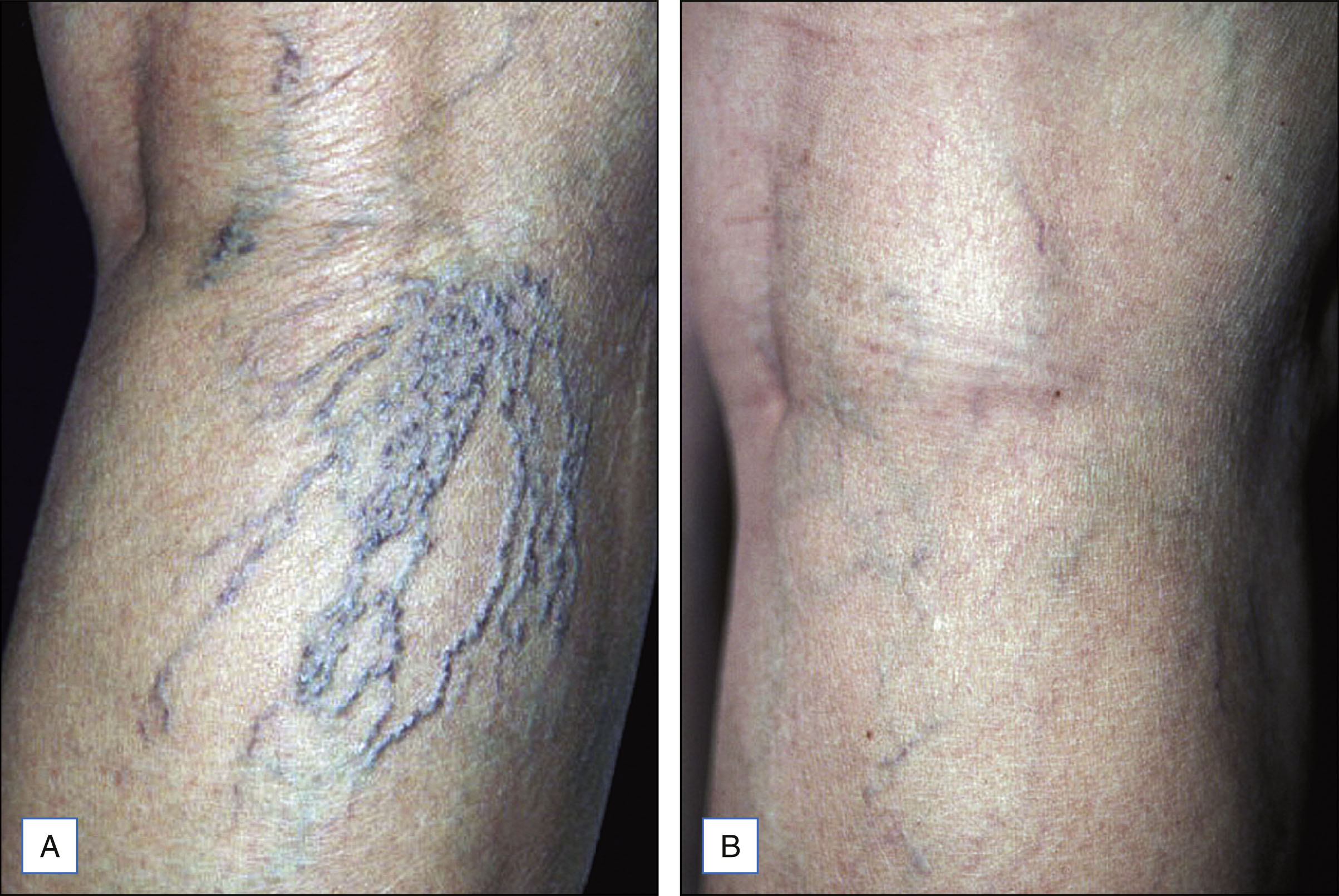 A two-panel photo sequence shows the side of a leg before and after treatment with visibility of varicose veins. The photo sequence consists of two panels. Panel A shows the side of a leg with prominent varicose veins visible in a branching pattern. Panel B shows the same area after treatment, with the veins significantly reduced and the skin appearing smoother.