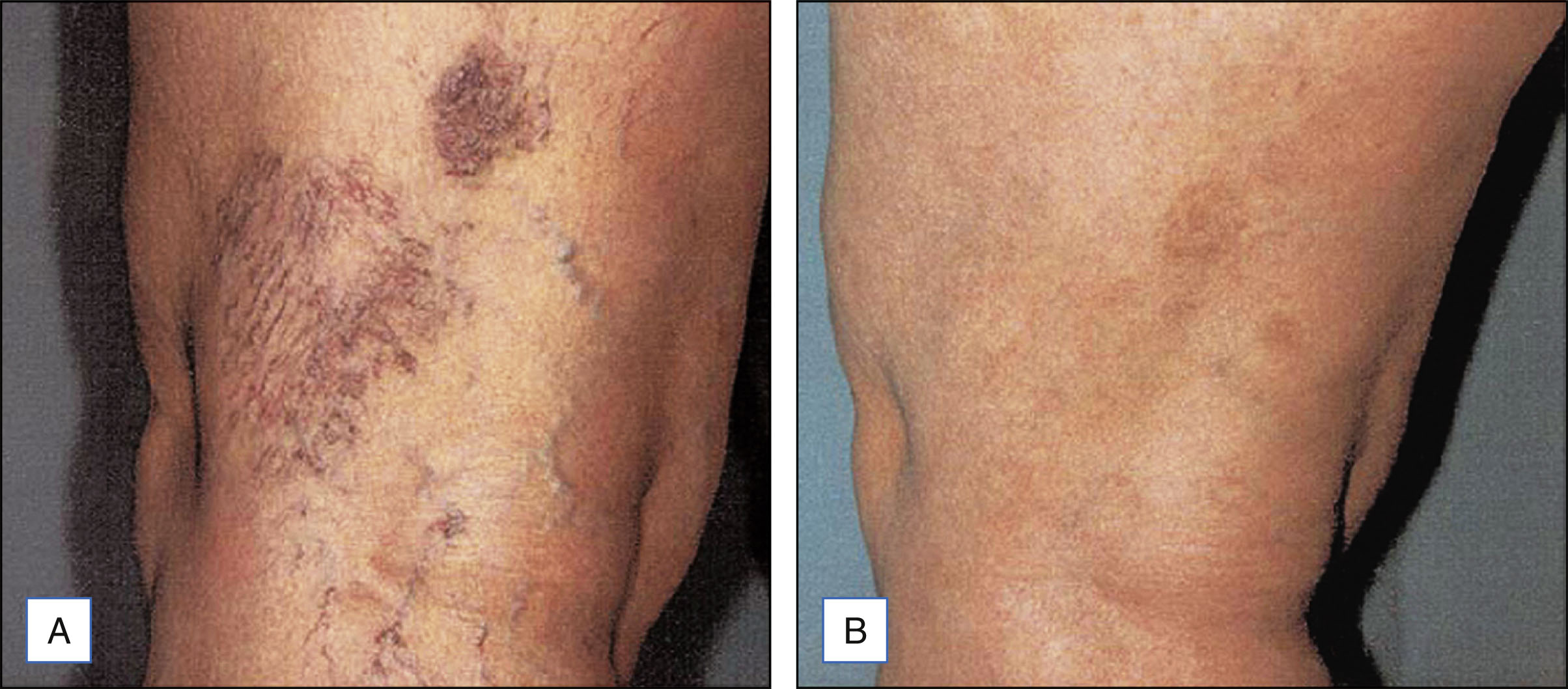 A two-panel photo sequence shows a lower leg with varicose veins before and after laser treatment, with vein appearance. The photo sequence contains two panels. Panel A shows the lower leg with multiple visible varicose veins across the surface, concentrated on the side and back. Panel B shows the same area after treatment, where the varicose veins are significantly reduced and the skin appears more uniform. The panels are positioned side by side, focusing on the leg area.