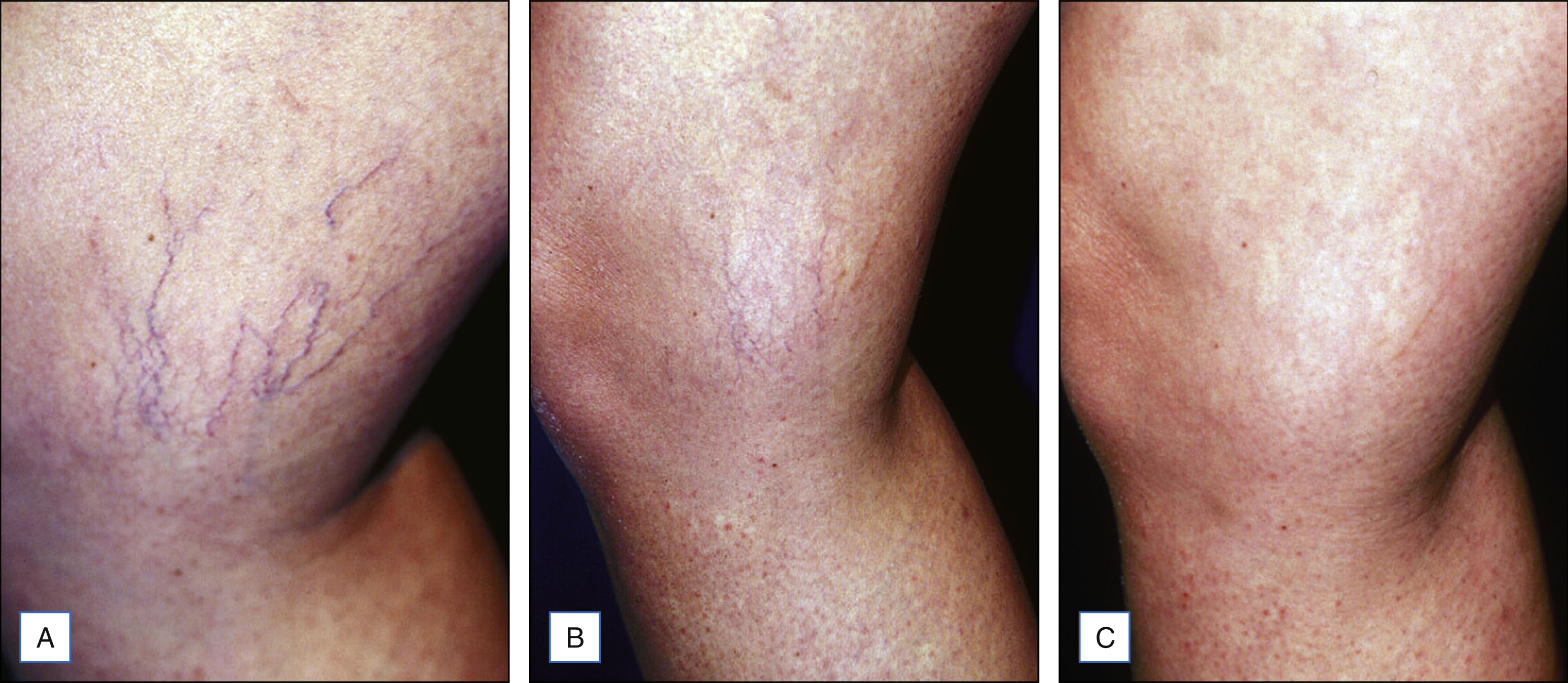 A three-panel photo sequence shows the inner knee with vessels before treatment, after two treatments, and at 10 months follow-up with near complete resolution. The photo sequence contains three panels. Panel A shows the inner knee with several visible vessels of varying sizes spread across the skin surface. Panel B shows the same area 3 months after two treatments, where the larger vessels are no longer visible and the smaller vessels appear faded. Panel C shows the same area 10 months after the second treatment, where the vessels are almost completely resolved with only faint traces visible. The panels are arranged from left to right, showing the progression.