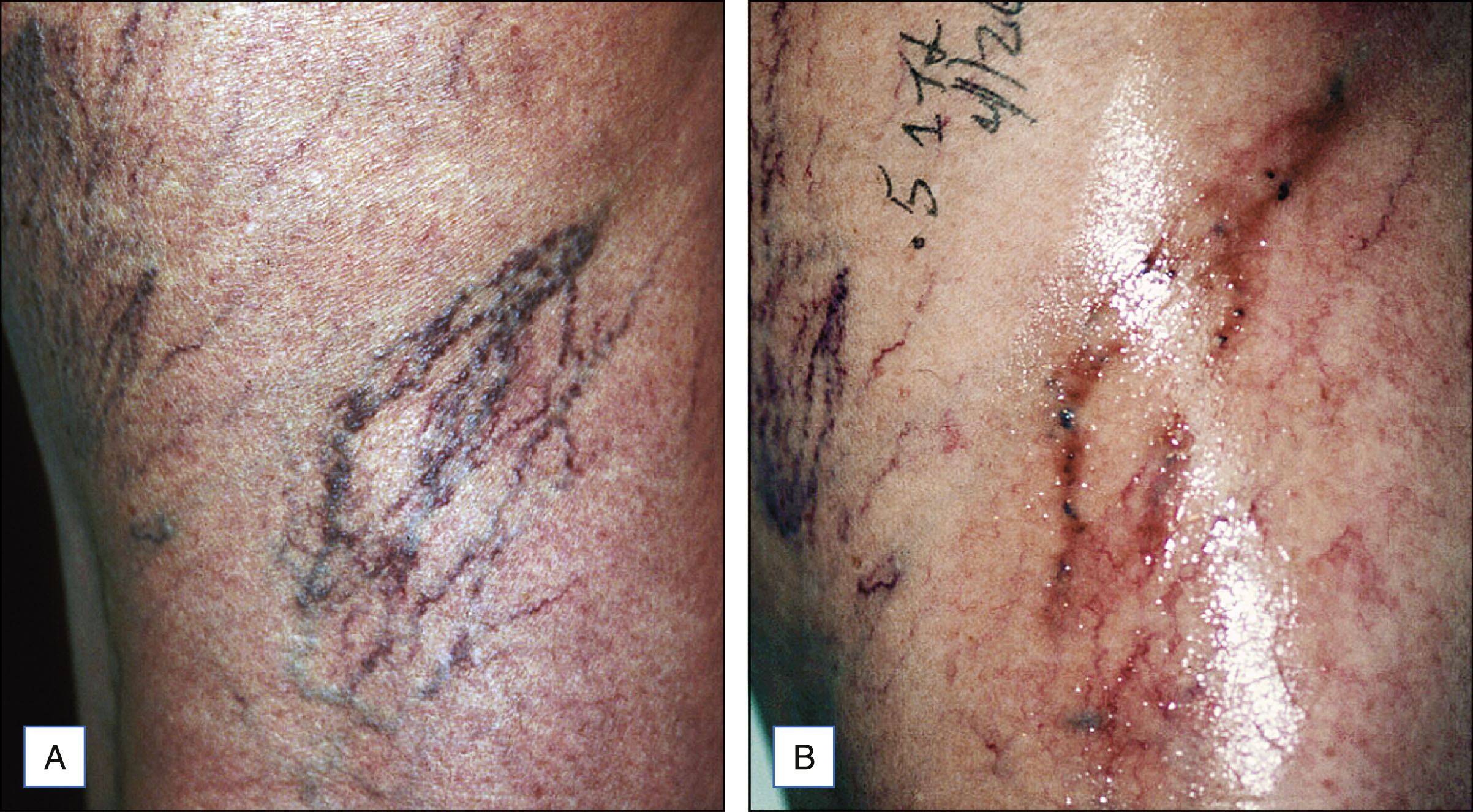A two-panel photo sequence shows pretreatment vessels on the leg and a follow-up with visible pigmentation after treatment. The photo sequence contains two panels. Panel A shows the lower leg with thin elevated tortuous vessels visible on the skin surface. The vessels appear in a cluster with varying lengths and diameters. Panel B shows the same area after treatment, where the vessels are no longer prominent, but the skin presents areas of visible pigmentation and residual markings.