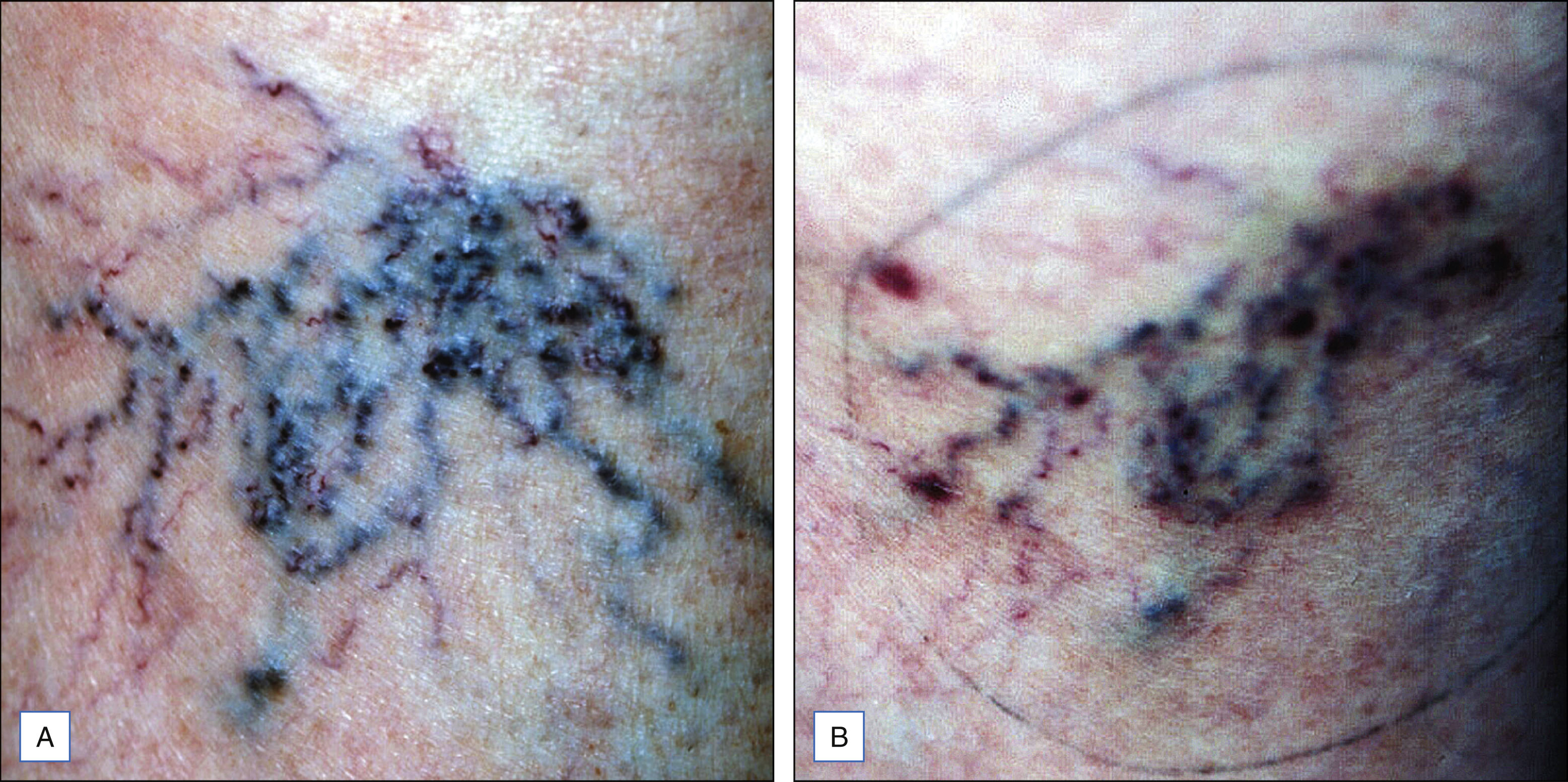 A two-panel photo sequence shows pretreatment elevated vessels on the leg and a follow-up with vessel prominence after treatment. The photo sequence contains two panels. Panel A shows the pretreatment view of the lower leg with multiple clustered elevated tortuous vessels of varying diameters distributed across the skin surface. Panel B shows the same area after treatment, where the vessels appear less prominent with partial clearing, but some residual vessel markings and faint traces remain.
