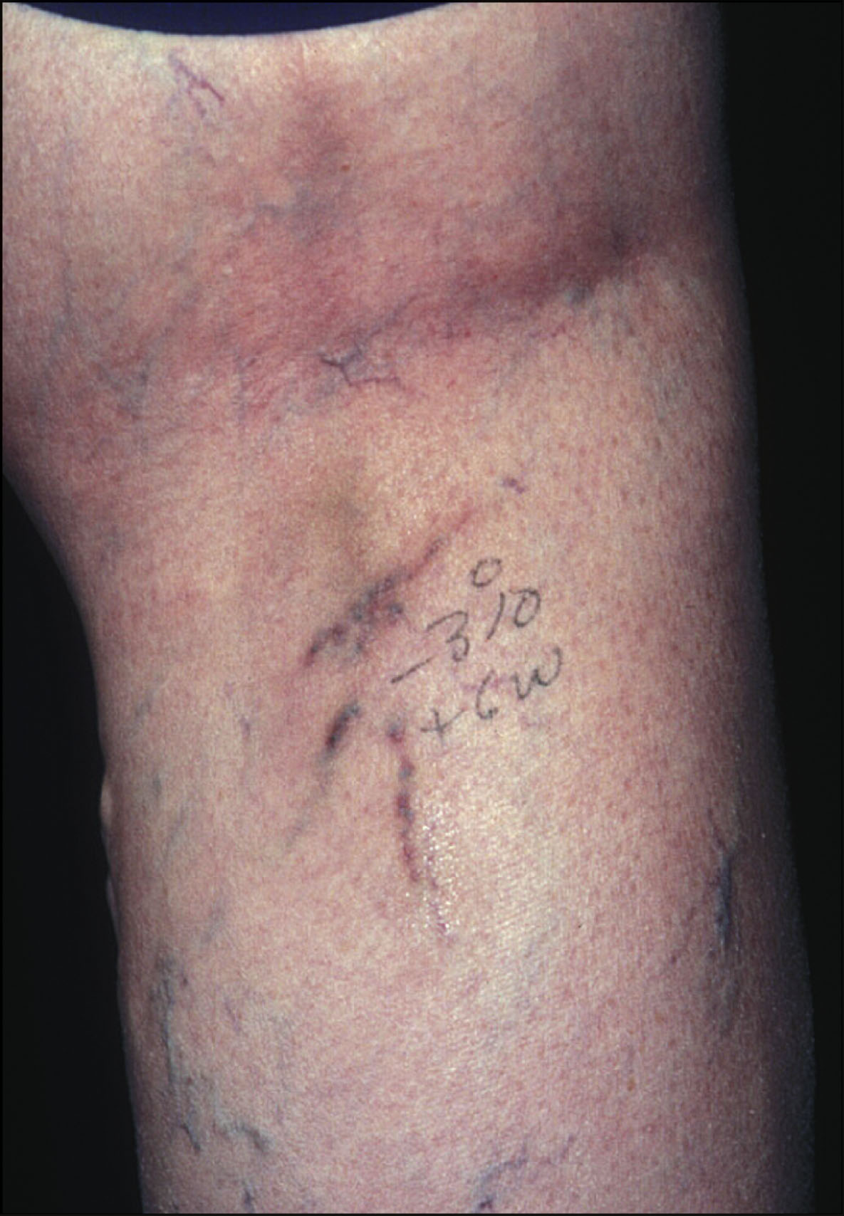 A photo features a lower leg showing scattered small vessels and areas of darkened patches following treatment. The photo features a lower leg displaying an anterior view with multiple small scattered vessels that have irregular branching patterns. Darkened patches appear along the course of some vessels. The vessels appear collapsed with varying intensity of residual pigmentation spread across the treated area.