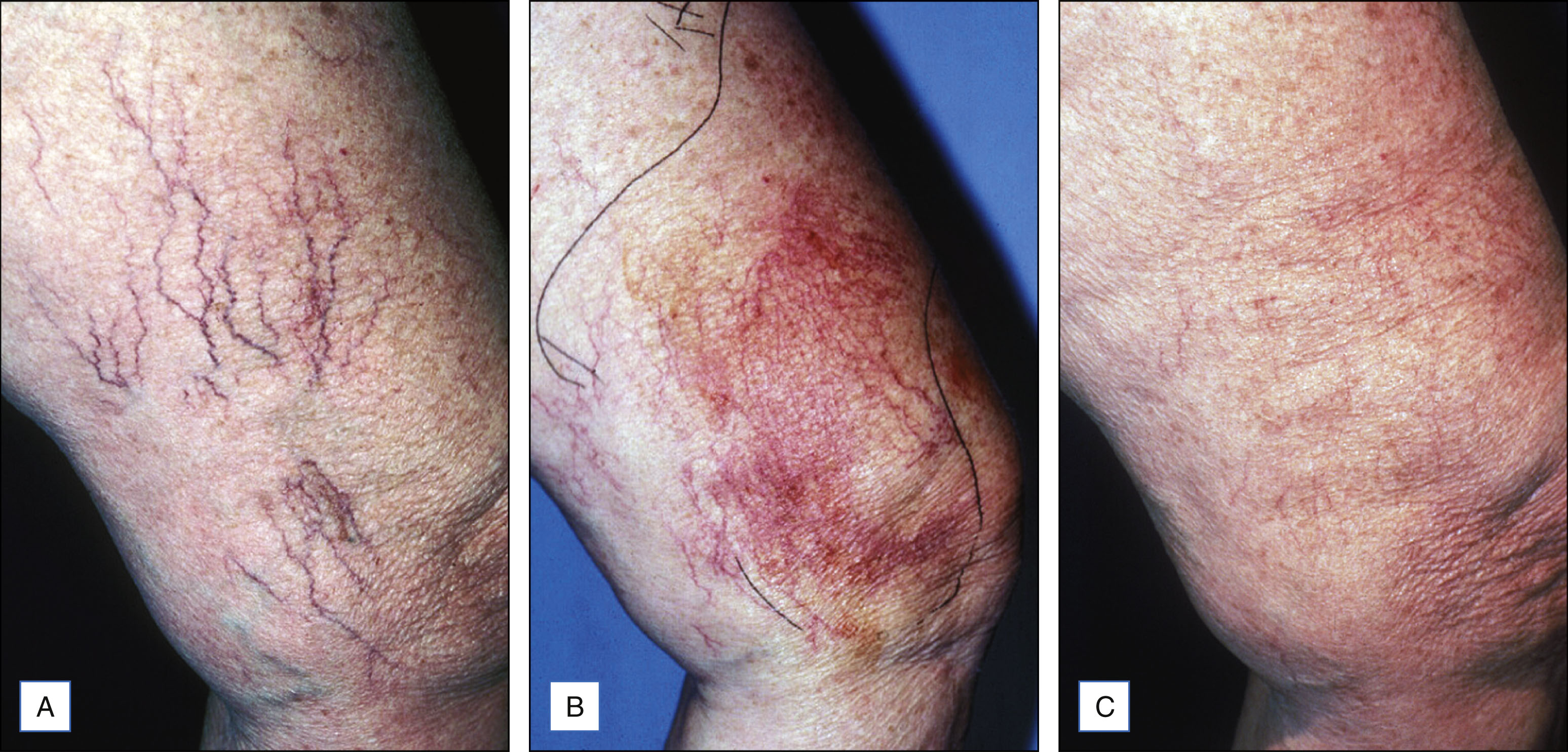 A sequence of three photo panels shows changes in vessels of the inner knee over one year with visible neovascularization and later resolution. The sequence of three photo panels is labeled A to C. In the first panel labeled A, multiple thin branching vessels of varying sizes from small to medium are seen clustered along the skin surface. In the second panel labeled B, the vessels appear denser and more intertwined with extensive new vessel formation, distributed irregularly across the area. In the third panel labeled C, the vessels are faint and show significant reduction in density, with only a few scattered small vessels remaining.