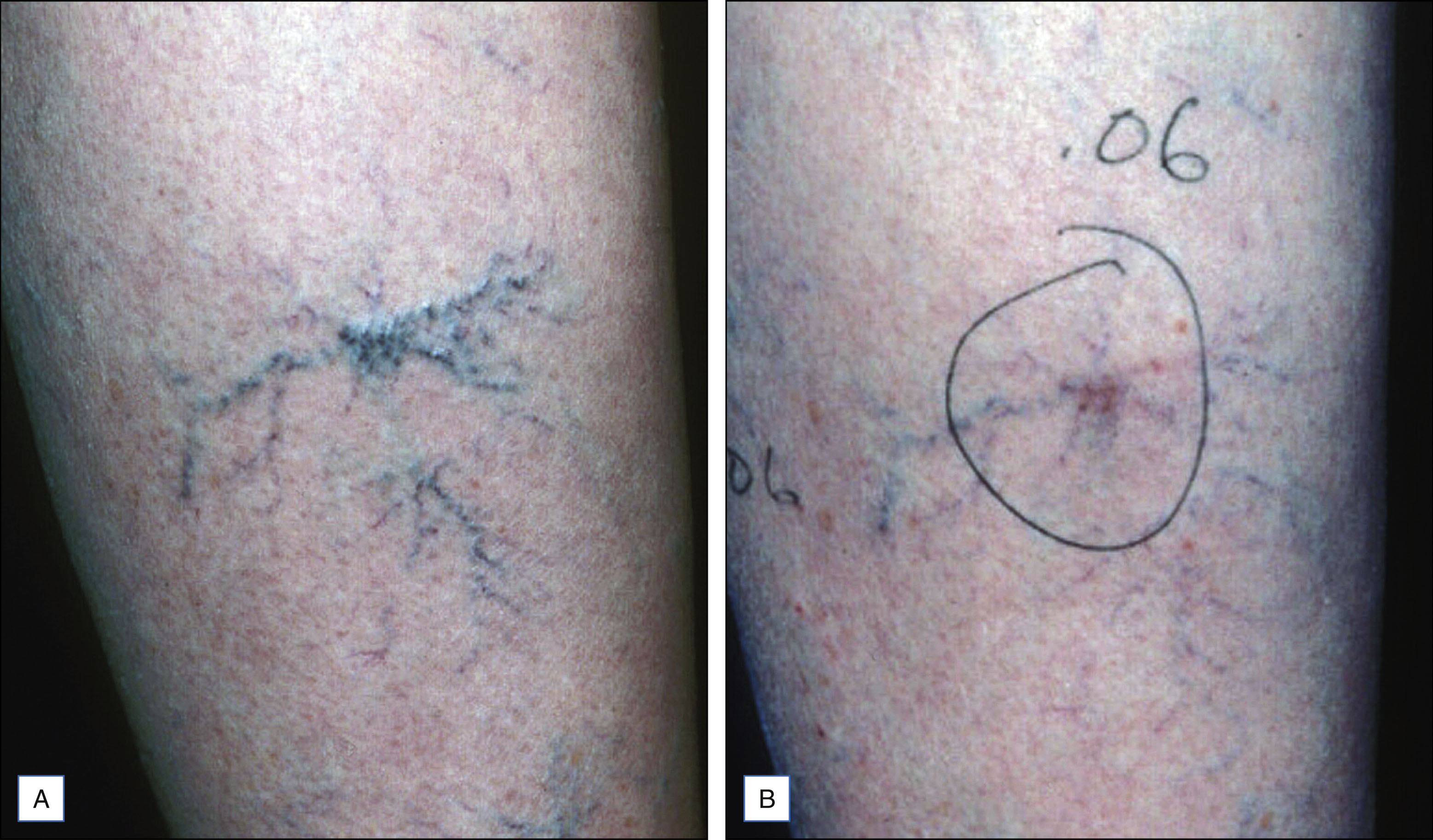 A two-panel photo shows elevated tortuous vessels before treatment and vessels with a circular marking after treatment. The two-panel photo is labeled A and B. In the left panel labeled A, multiple branching vessels appear raised and tortuous with varied thickness ranging from medium to fine size. In the right panel labeled B, the vessels are visible with some remaining faint lines. A hand-drawn circle is present on the skin with the marking 0.6 written above it, indicating a specific area of attention.