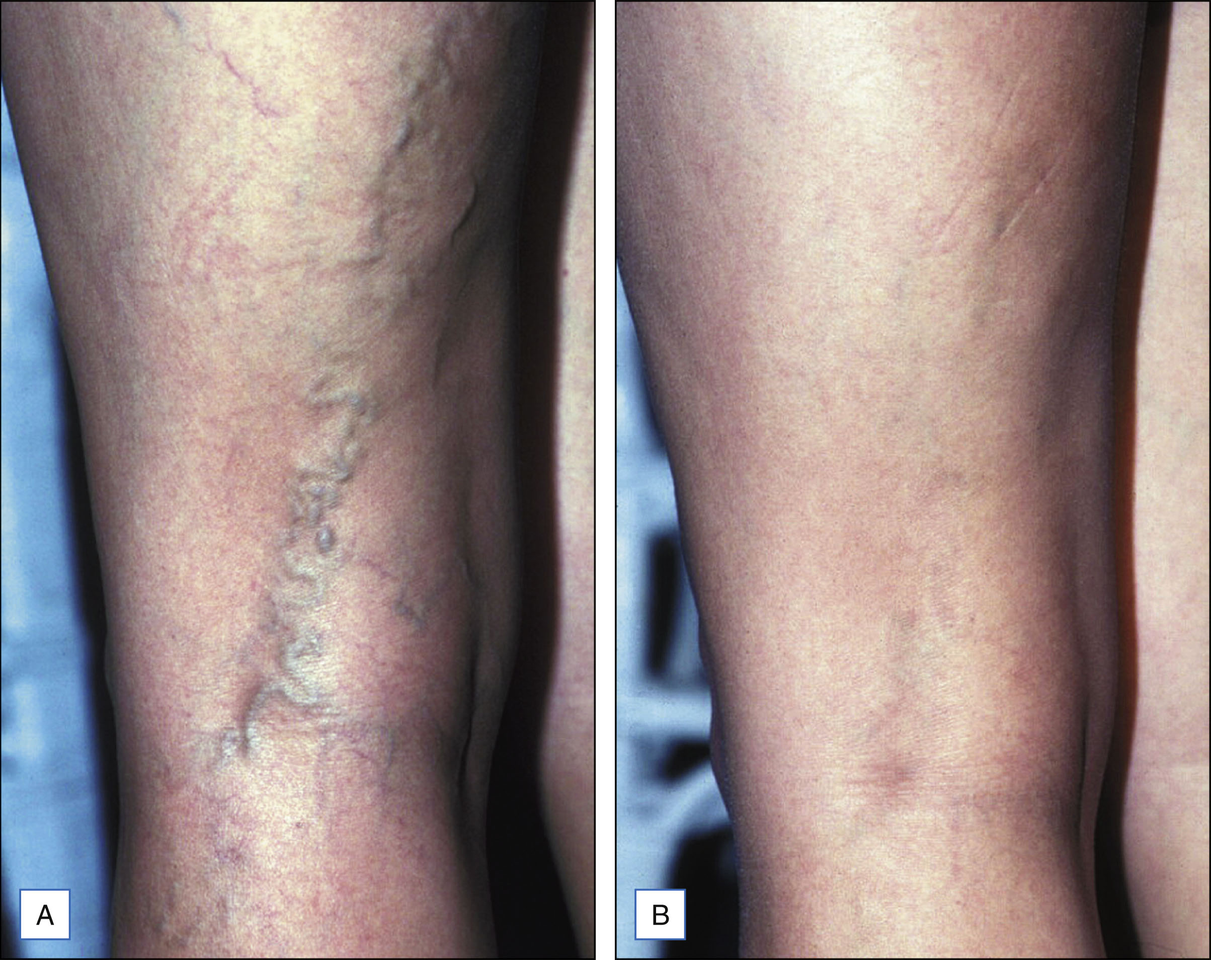 A two-panel photo shows a large vessel on a lower leg before treatment and its complete removal without visible pigmentation after treatment. The two-panel photo is labeled A and B. In the left panel, a section of the lower leg displays a prominent, branching vessel extending along the surface of the skin. In the right panel, the same area shows no visible vessel, and the skin appears smooth without pigmentation or scarring.