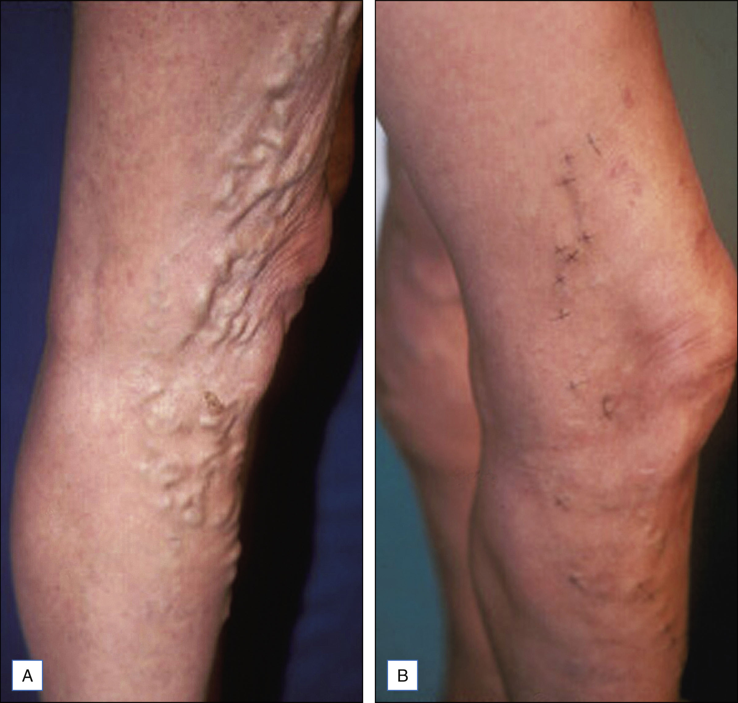 A two-panel photo shows large varicose veins on a leg in the left panel and almost complete resolution with minimal markings in the right panel after treatment. The two-panel photo is labeled A and B. In the left panel, labeled A, the lower leg displays multiple large, twisted varicose veins bulging from the skin surface. In the right panel, labeled B, the same area shows almost complete disappearance of the veins, with minimal visible markings remaining.