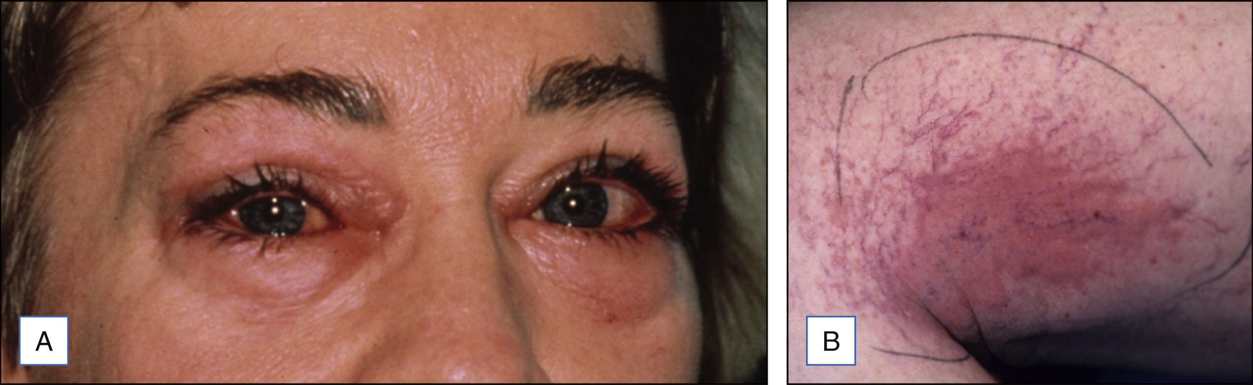 A pair of photo panels shows swelling around the eyes and a skin reaction with a marked circle on an arm. The pair of photo panels is labeled A and B. The left panel, labeled A, shows a close-up of a person’s face with the area around both eyes appearing swollen. The right panel, labeled B, shows an area on an arm with a raised patch inside a hand-drawn circle, indicating the site of skin reaction.