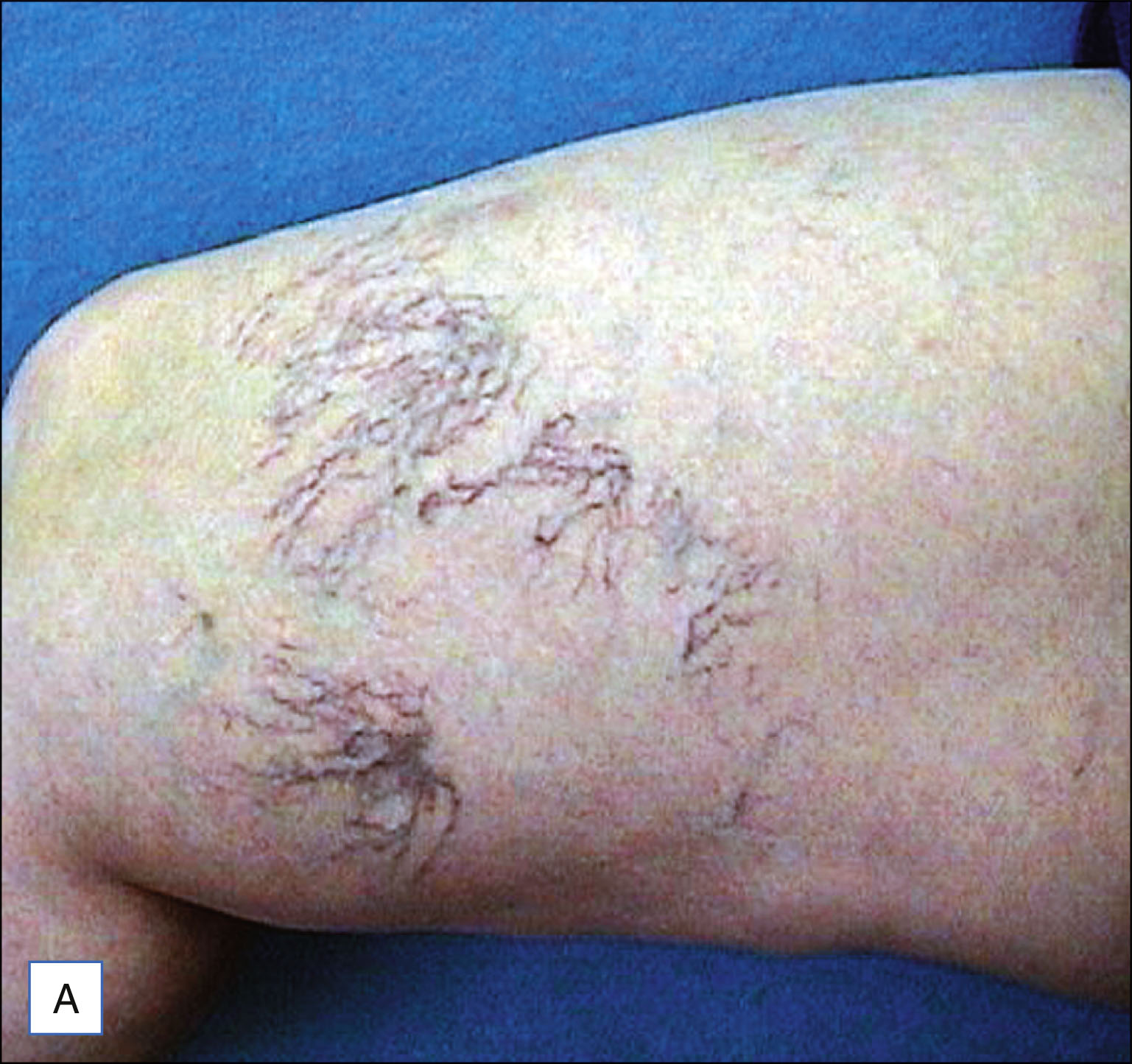 A set of six labeled photos shows three patients with visible leg veins before treatment on the left and reduced visibility of veins after treatment on the right. The set of six labeled photos is labeled A to F. The top row shows photos labeled A and B. Photo A shows a leg with multiple visible thin veins. Photo B shows the same leg with fewer visible veins. The middle row includes photos C and D. Photo C shows a leg with several fine veins along the surface. Photo D shows the same leg with less prominent veins. The bottom row includes photos E and F. Photo E shows a leg with a few visible veins around the knee. Photo F shows the same leg with mostly smooth skin and reduced vein visibility. Each row includes one pretreatment and one post-treatment photo.
