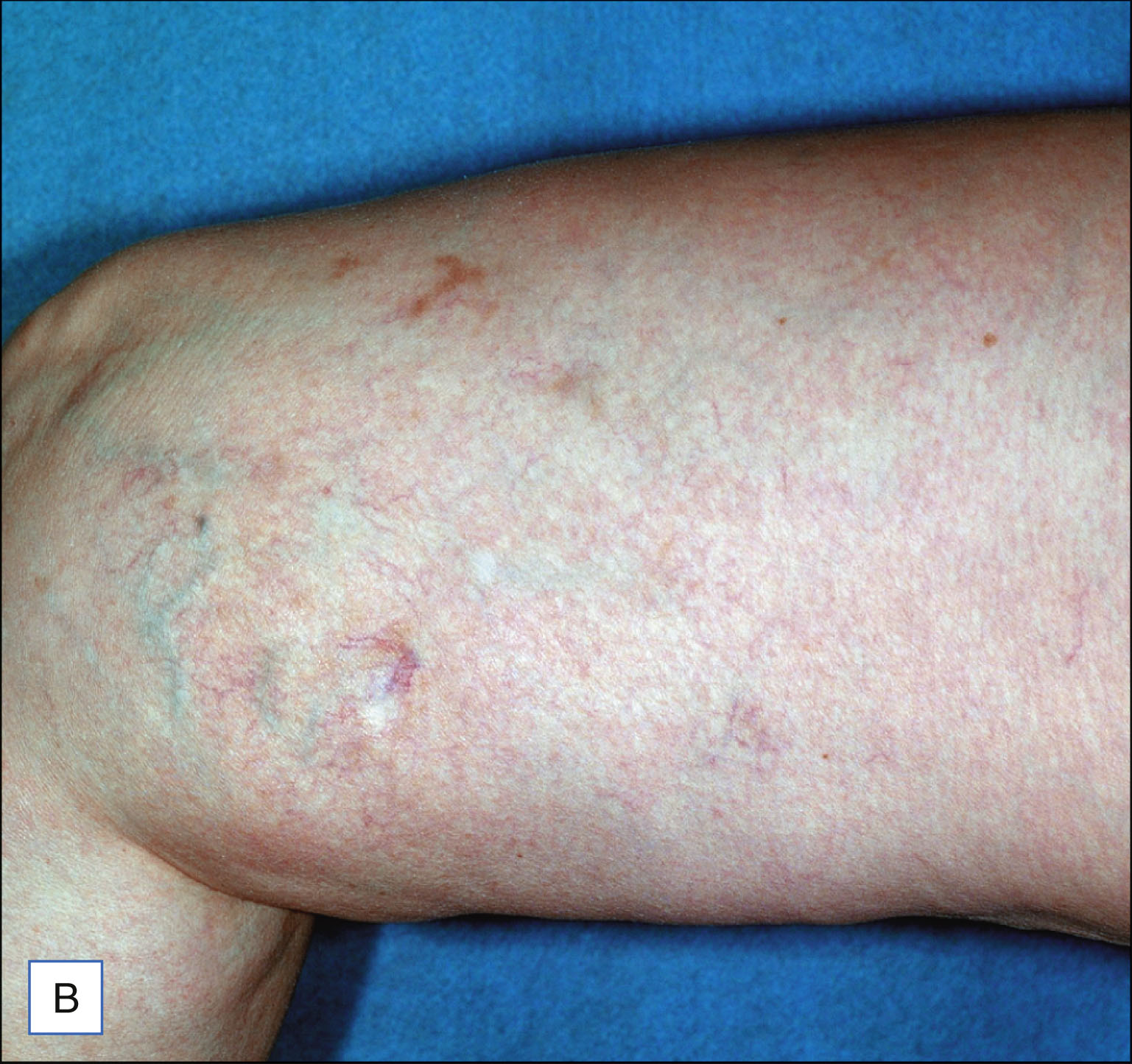 A set of six labeled photos shows three patients with visible leg veins before treatment on the left and reduced visibility of veins after treatment on the right. The set of six labeled photos is labeled A to F. The top row shows photos labeled A and B. Photo A shows a leg with multiple visible thin veins. Photo B shows the same leg with fewer visible veins. The middle row includes photos C and D. Photo C shows a leg with several fine veins along the surface. Photo D shows the same leg with less prominent veins. The bottom row includes photos E and F. Photo E shows a leg with a few visible veins around the knee. Photo F shows the same leg with mostly smooth skin and reduced vein visibility. Each row includes one pretreatment and one post-treatment photo.