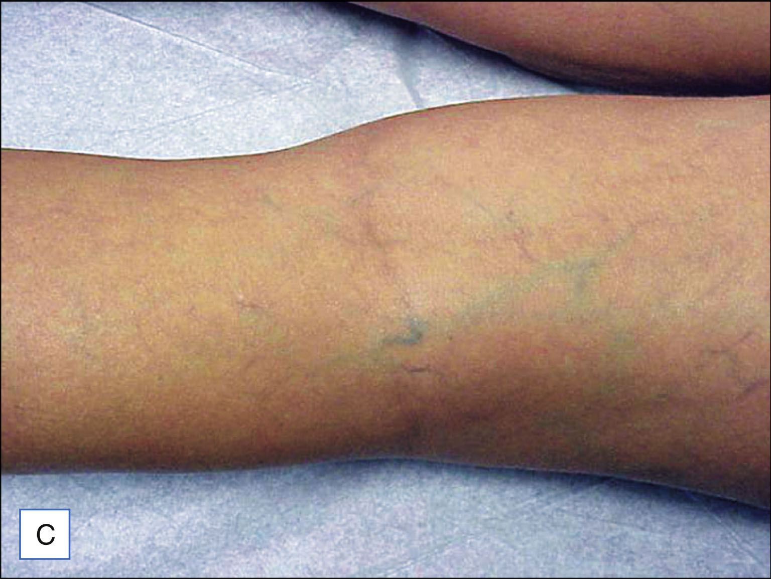 A set of six labeled photos shows three patients with visible leg veins before treatment on the left and reduced visibility of veins after treatment on the right. The set of six labeled photos is labeled A to F. The top row shows photos labeled A and B. Photo A shows a leg with multiple visible thin veins. Photo B shows the same leg with fewer visible veins. The middle row includes photos C and D. Photo C shows a leg with several fine veins along the surface. Photo D shows the same leg with less prominent veins. The bottom row includes photos E and F. Photo E shows a leg with a few visible veins around the knee. Photo F shows the same leg with mostly smooth skin and reduced vein visibility. Each row includes one pretreatment and one post-treatment photo.