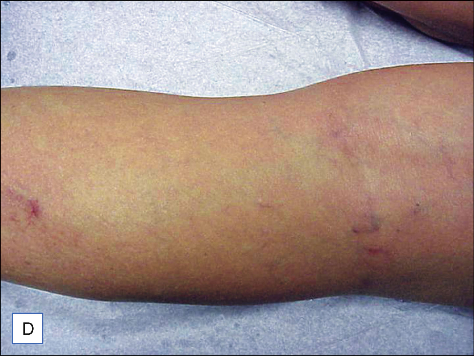 A set of six labeled photos shows three patients with visible leg veins before treatment on the left and reduced visibility of veins after treatment on the right. The set of six labeled photos is labeled A to F. The top row shows photos labeled A and B. Photo A shows a leg with multiple visible thin veins. Photo B shows the same leg with fewer visible veins. The middle row includes photos C and D. Photo C shows a leg with several fine veins along the surface. Photo D shows the same leg with less prominent veins. The bottom row includes photos E and F. Photo E shows a leg with a few visible veins around the knee. Photo F shows the same leg with mostly smooth skin and reduced vein visibility. Each row includes one pretreatment and one post-treatment photo.