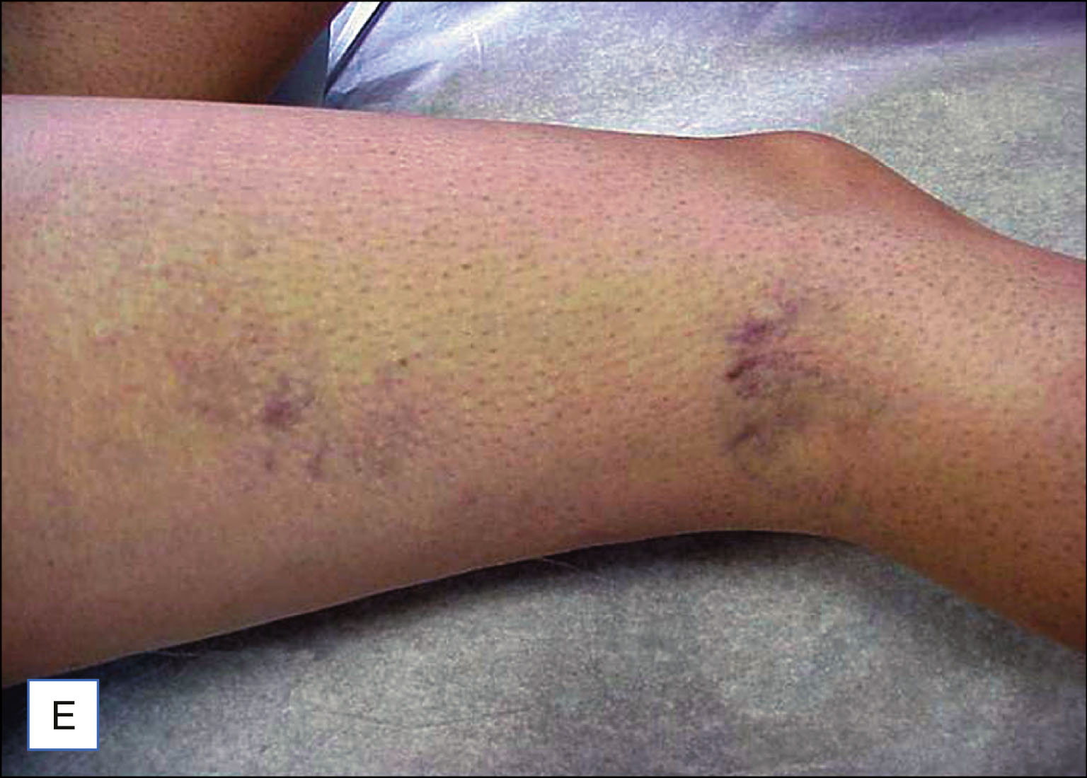 A set of six labeled photos shows three patients with visible leg veins before treatment on the left and reduced visibility of veins after treatment on the right. The set of six labeled photos is labeled A to F. The top row shows photos labeled A and B. Photo A shows a leg with multiple visible thin veins. Photo B shows the same leg with fewer visible veins. The middle row includes photos C and D. Photo C shows a leg with several fine veins along the surface. Photo D shows the same leg with less prominent veins. The bottom row includes photos E and F. Photo E shows a leg with a few visible veins around the knee. Photo F shows the same leg with mostly smooth skin and reduced vein visibility. Each row includes one pretreatment and one post-treatment photo.