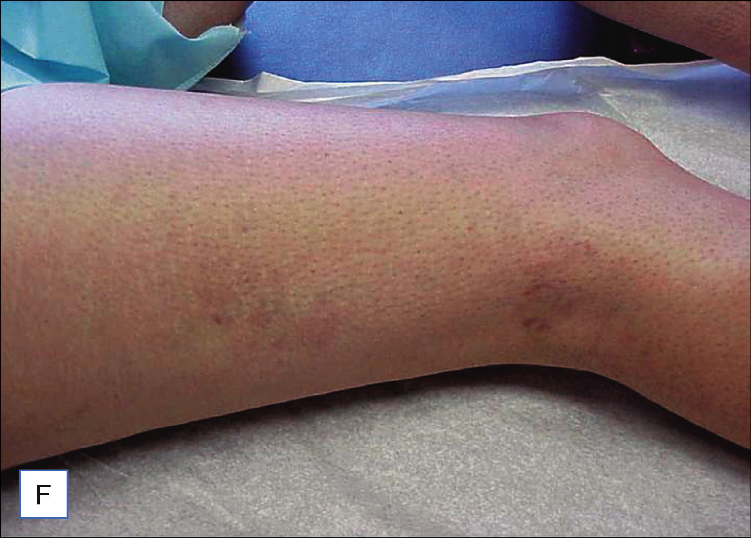 A set of six labeled photos shows three patients with visible leg veins before treatment on the left and reduced visibility of veins after treatment on the right. The set of six labeled photos is labeled A to F. The top row shows photos labeled A and B. Photo A shows a leg with multiple visible thin veins. Photo B shows the same leg with fewer visible veins. The middle row includes photos C and D. Photo C shows a leg with several fine veins along the surface. Photo D shows the same leg with less prominent veins. The bottom row includes photos E and F. Photo E shows a leg with a few visible veins around the knee. Photo F shows the same leg with mostly smooth skin and reduced vein visibility. Each row includes one pretreatment and one post-treatment photo.