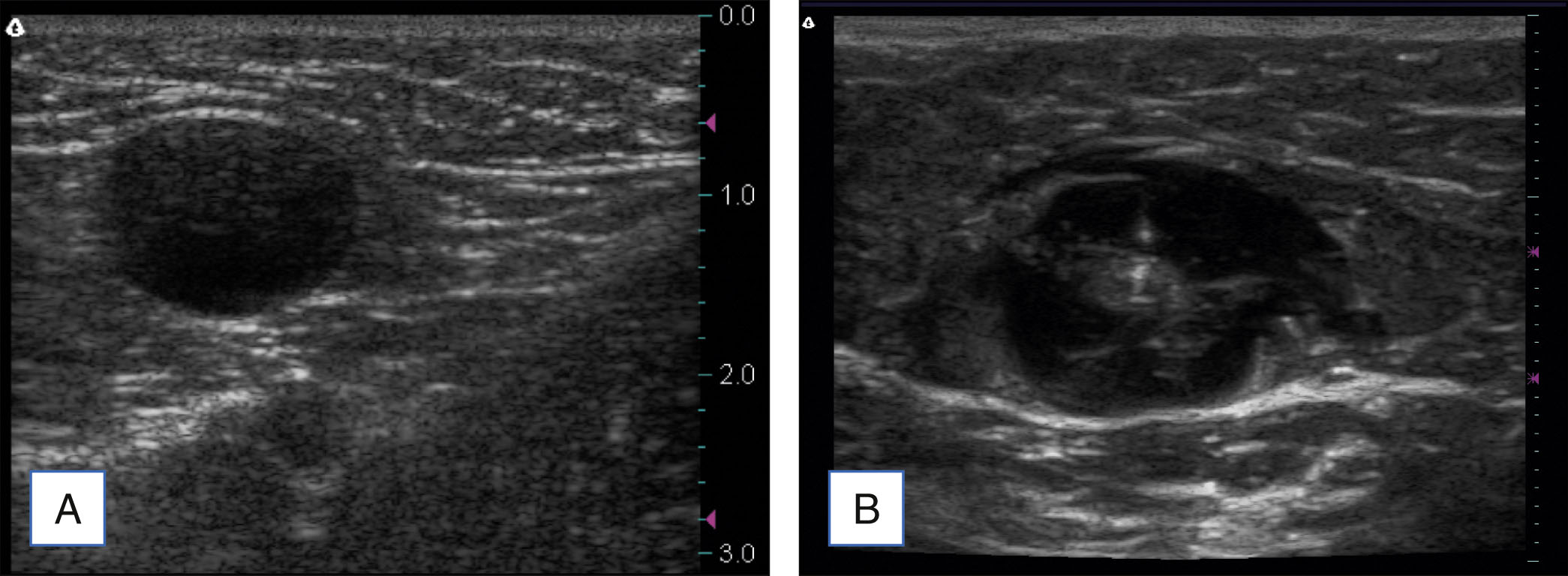 An ultrasound comparison shows a round dark structure in part A and the same structure surrounded by a dark ring in part B. The ultrasound comparison is labeled with parts A and B. Part A shows an axial ultrasound view with a round dark structure in the center surrounded by horizontal layered patterns. A vertical scale appears on the right side from 0 to 3. Part B shows a similar ultrasound view where the same central dark structure is now surrounded by a larger dark ring. Layered patterns remain visible above and below the structure.