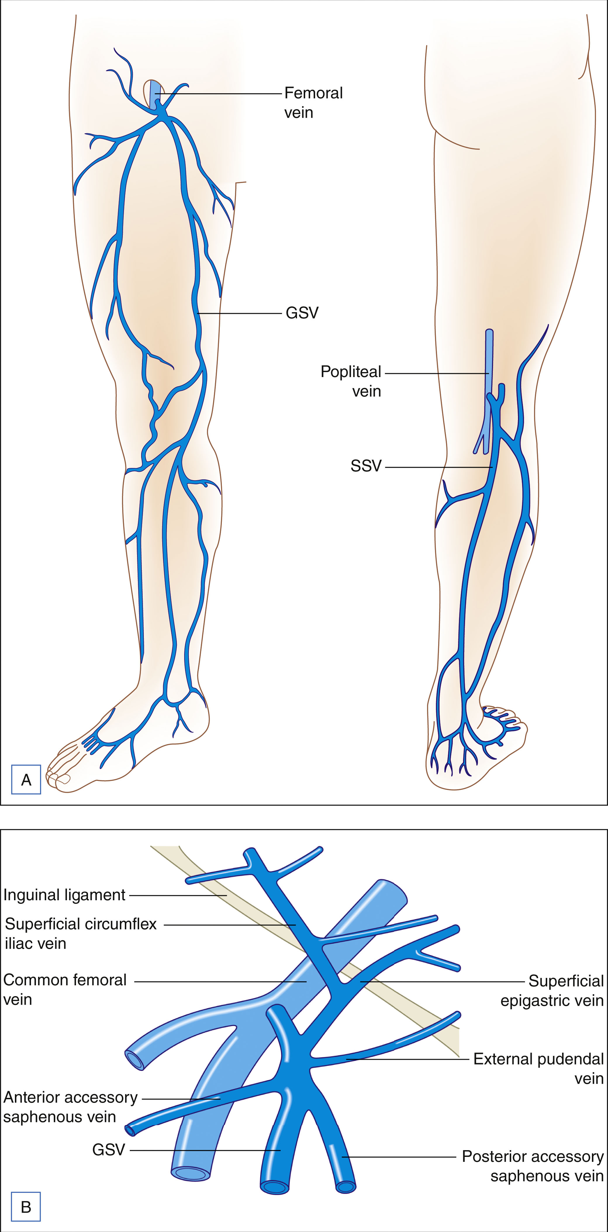 An anatomical illustration labeled A and B shows leg veins, including the great and small saphenous veins, and a detailed view of the right saphenofemoral junction. The anatomical illustration's top section, labeled A, shows front and back views of the leg. Labeled veins include the femoral vein, great saphenous vein, small saphenous vein, popliteal vein, and G S V. Veins are drawn along the entire length of the leg and foot. The bottom section labeled B shows a close view of the right saphenofemoral junction with branching labeled veins. Labels include epigastric ligament, femoral vein, superficial circumflex iliac vein, anterior femoral cutaneous vein, anterior accessory saphenous vein, external pudendal vein, and posterior accessory saphenous vein. All veins connect centrally around the femoral and great saphenous veins.