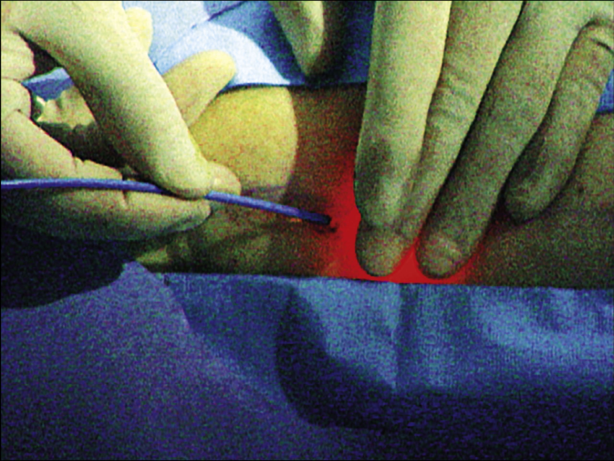 A photo features a medical procedure that shows gloved hands guiding a laser fiber with a visible light spot under the skin.