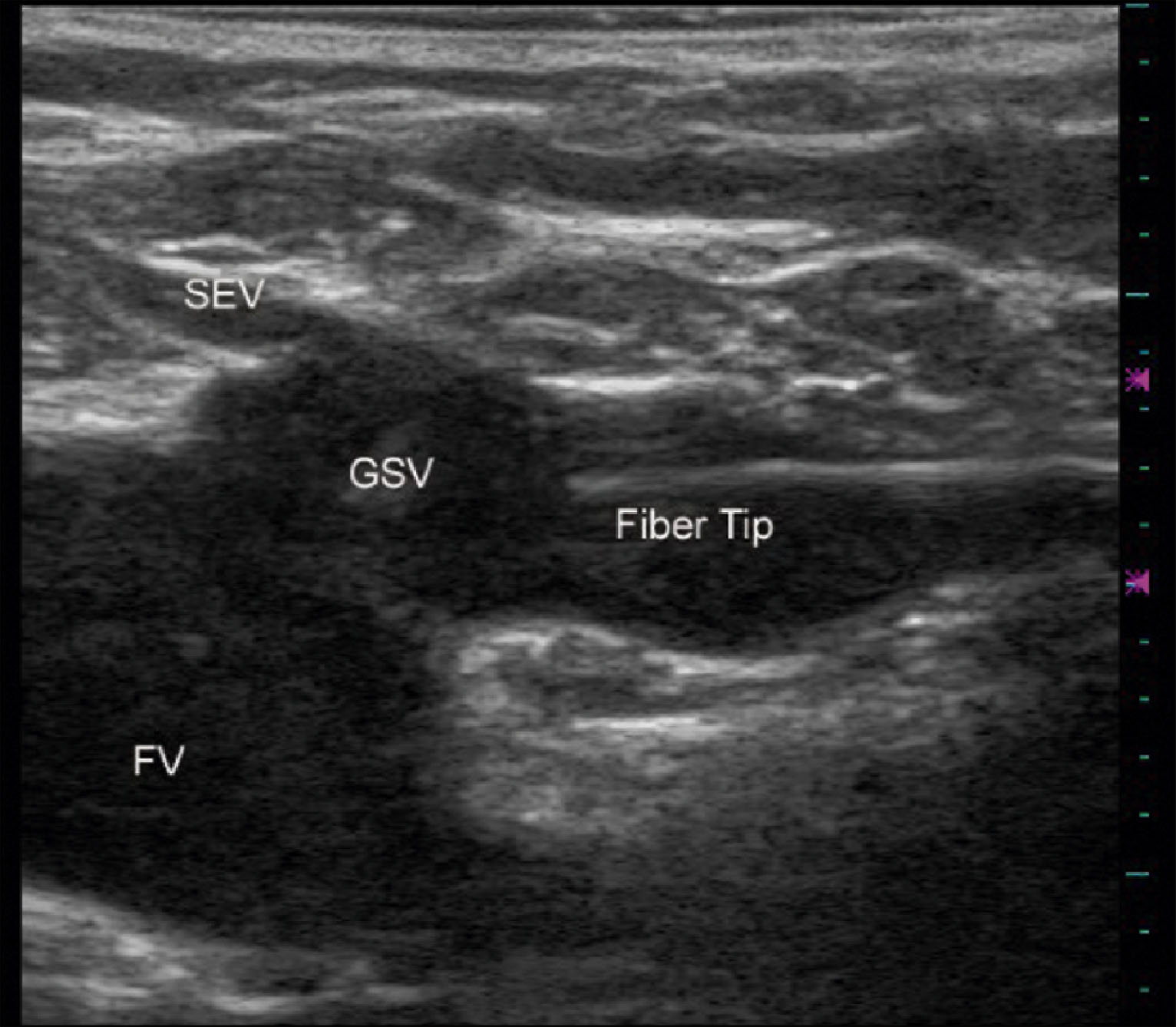 An ultrasound scan shows the great saphenous vein, superficial epigastric vein, femoral vein, and fiber tip labeled. The scan presents a sagittal ultrasound view with four labels. The label S E V marks the superficial epigastric vein near the top left. The label G S V marks the great saphenous vein in the center. The label Fiber Tip appears adjacent to the G S V. The label F V marks the femoral vein in the lower left area. A vertical scale with tick marks appears on the right border.