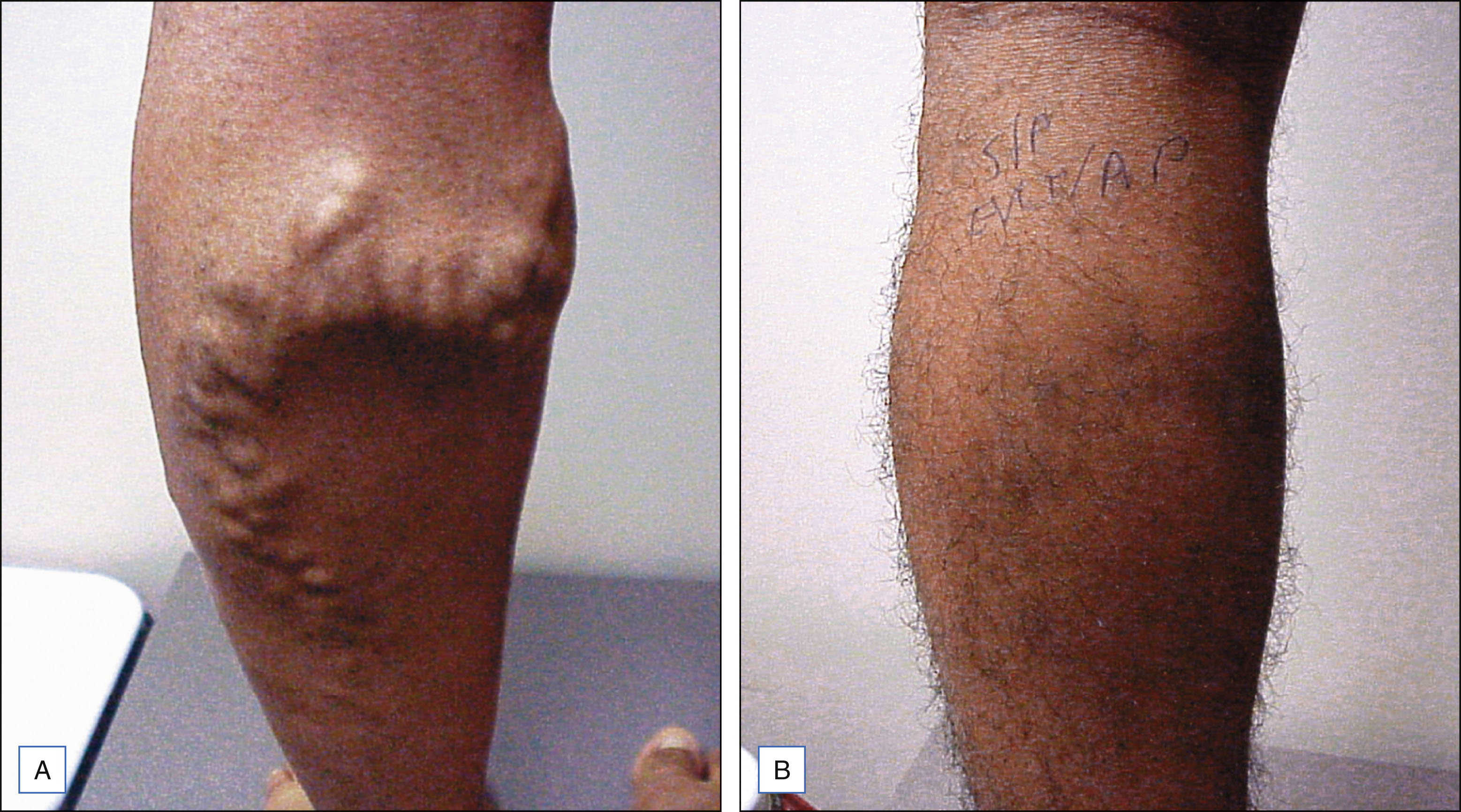 A pair of labeled leg photos shows bulging surface veins in photo A and smoother skin with no visible bulging in photo B. The pair of labeled leg photos is labeled A and B. Photo A shows the back of a lower leg with several raised, winding surface veins extending down the calf. The skin appears stretched around the bulges. Photo B shows the same leg one month later with a smoother surface, no visible bulging veins, and a few faint markings.