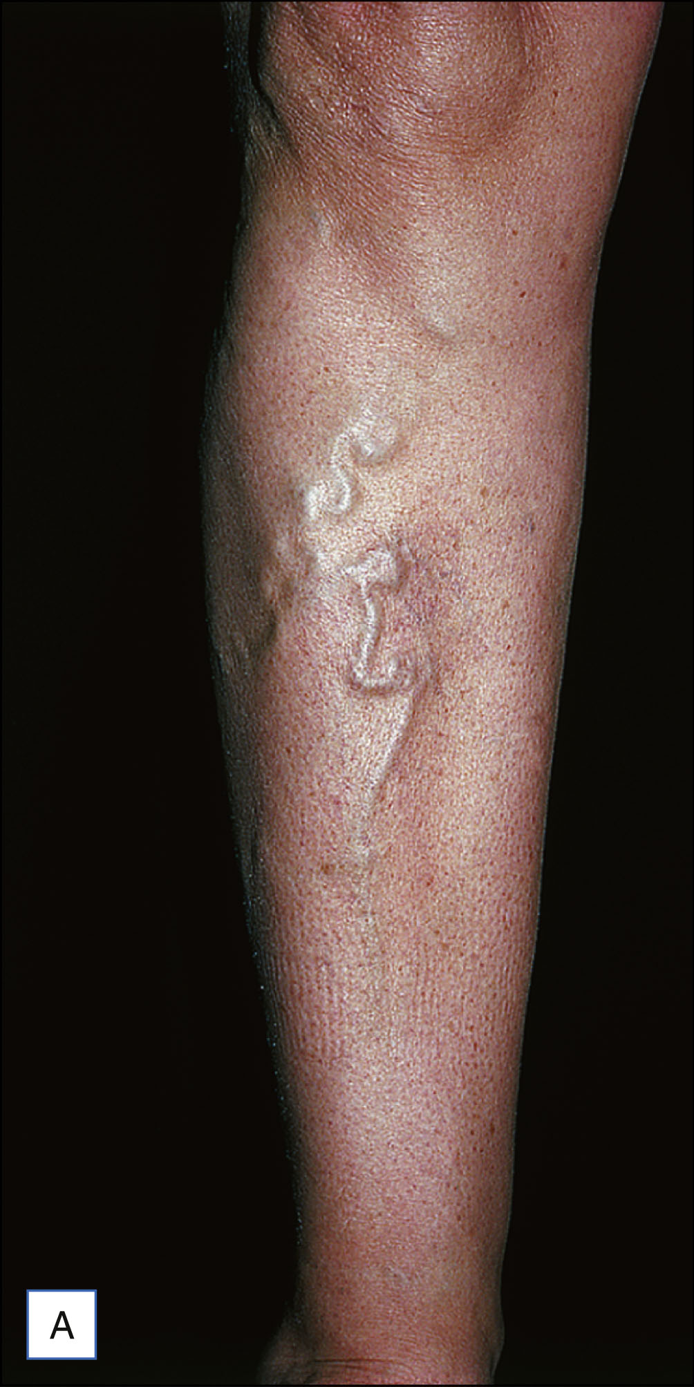 A pair of leg photos, labeled A and B, shows pretibial varicose veins before treatment and reduced veins six weeks after ambulatory phlebectomy, with both panels labeled for comparison.