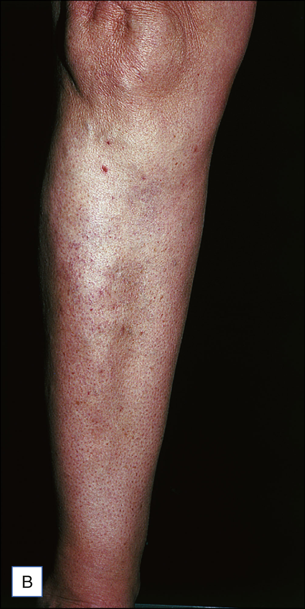 A pair of leg photos, labeled A and B, shows pretibial varicose veins before treatment and reduced veins six weeks after ambulatory phlebectomy, with both panels labeled for comparison.