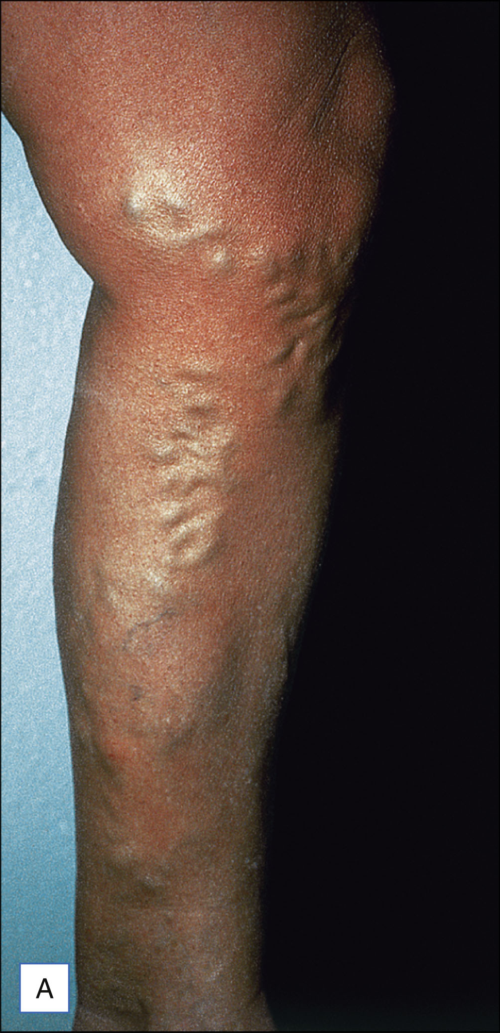 A pair of leg photos, labeled A and B, shows twisted varicose veins in the saphenous region before treatment and a smoother leg with reduced veins six weeks after ambulatory phlebectomy.
