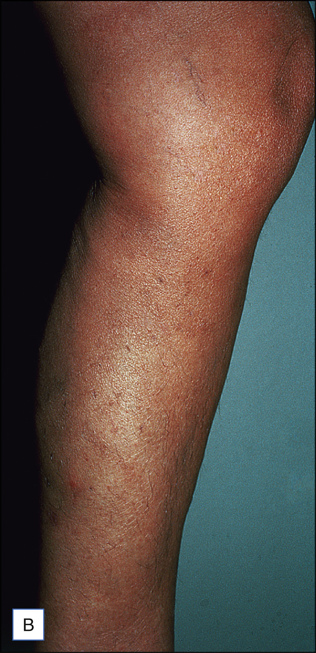 A pair of leg photos, labeled A and B, shows twisted varicose veins in the saphenous region before treatment and a smoother leg with reduced veins six weeks after ambulatory phlebectomy.