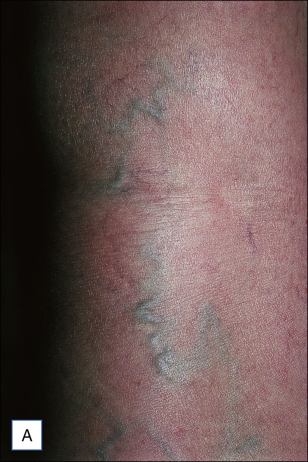 A pair of leg photos labeled A and B shows reticular varicose veins in a branching pattern before treatment and a smooth leg with no visible veins six weeks after ambulatory phlebectomy.