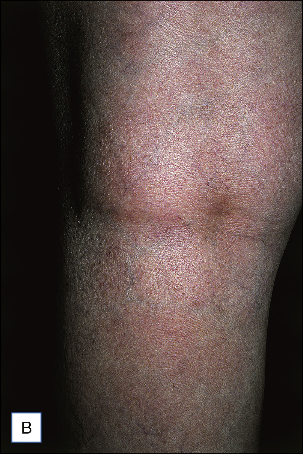 A pair of leg photos labeled A and B shows reticular varicose veins in a branching pattern before treatment and a smooth leg with no visible veins six weeks after ambulatory phlebectomy.