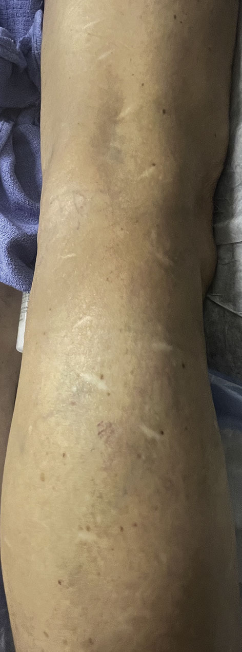 A leg with multiple linear scars running along the posterior lateral surface.