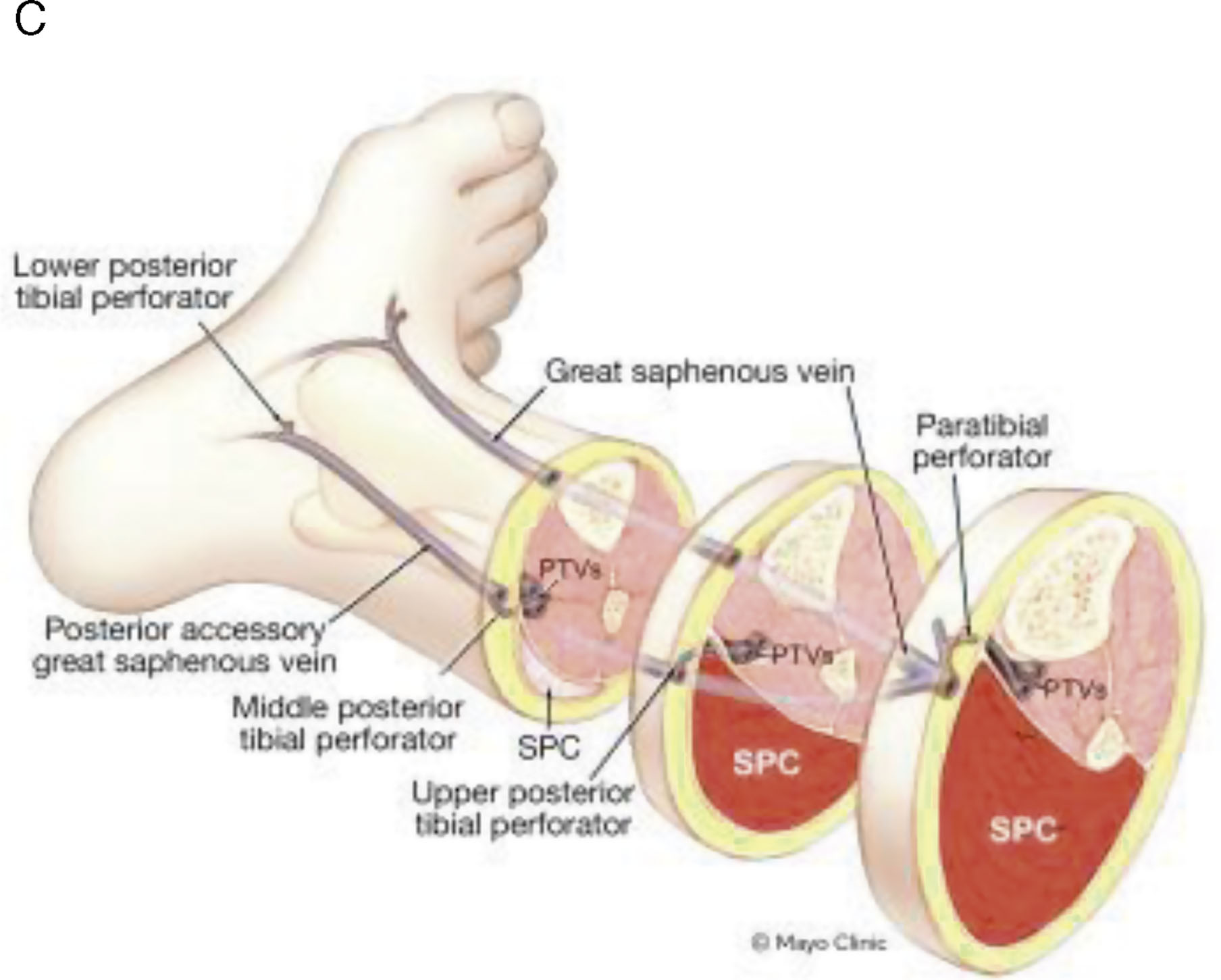 An anatomical diagram of the great saphenous vein, short saphenous vein, and perforators in the leg. The anatomical diagram includes three labeled panels, A, B, and C. Panel A shows the anatomy of the great saphenous vein along the medial aspect of the leg. Labeled structures include the superficial epigastric vein, accessory saphenous vein, superficial circumflex iliac vein, anterior cutaneous branch of femoral nerve, anterior accessory saphenous vein, posterior accessory saphenous vein, vein of Giacomini, medial marginal vein, and dorsal venous arch. Panel B shows the short saphenous vein along the posterior aspect of the lower leg with labels for sural nerve, vein of Giacomini, posterior accessory saphenous vein, lateral marginal vein, and dorsal venous arch. Panel C shows a cross-sectional diagram of the leg with labels for superficial vein, deep vein, musculofascial layer, and perforating vein. All three panels clearly show vein pathways and anatomical relationships with labeled branches and structures.