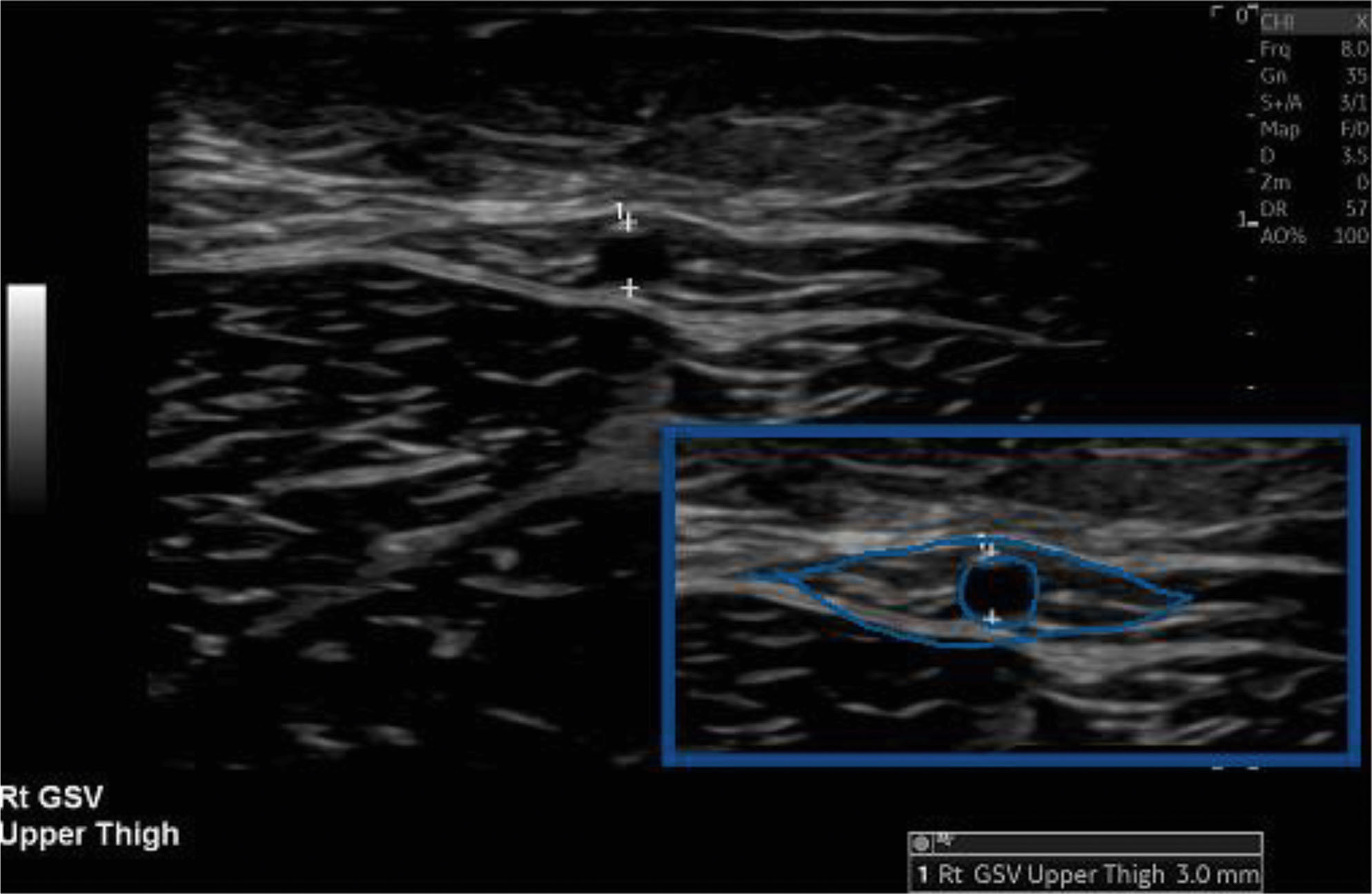 An ultrasound view of the great saphenous vein with an inset highlighting the saphenous eye. The ultrasound view labeled G S V for the great saphenous vein. Surrounding structures appear in the vein in cross-section. An inset box in the lower right highlights a magnified view of the same area, showing a circular structure within a fascial envelope, forming the saphenous eye. Labels include G S V and S F J for the saphenofemoral junction. The display includes standard ultrasound markers such as depth scale and bar on the right.