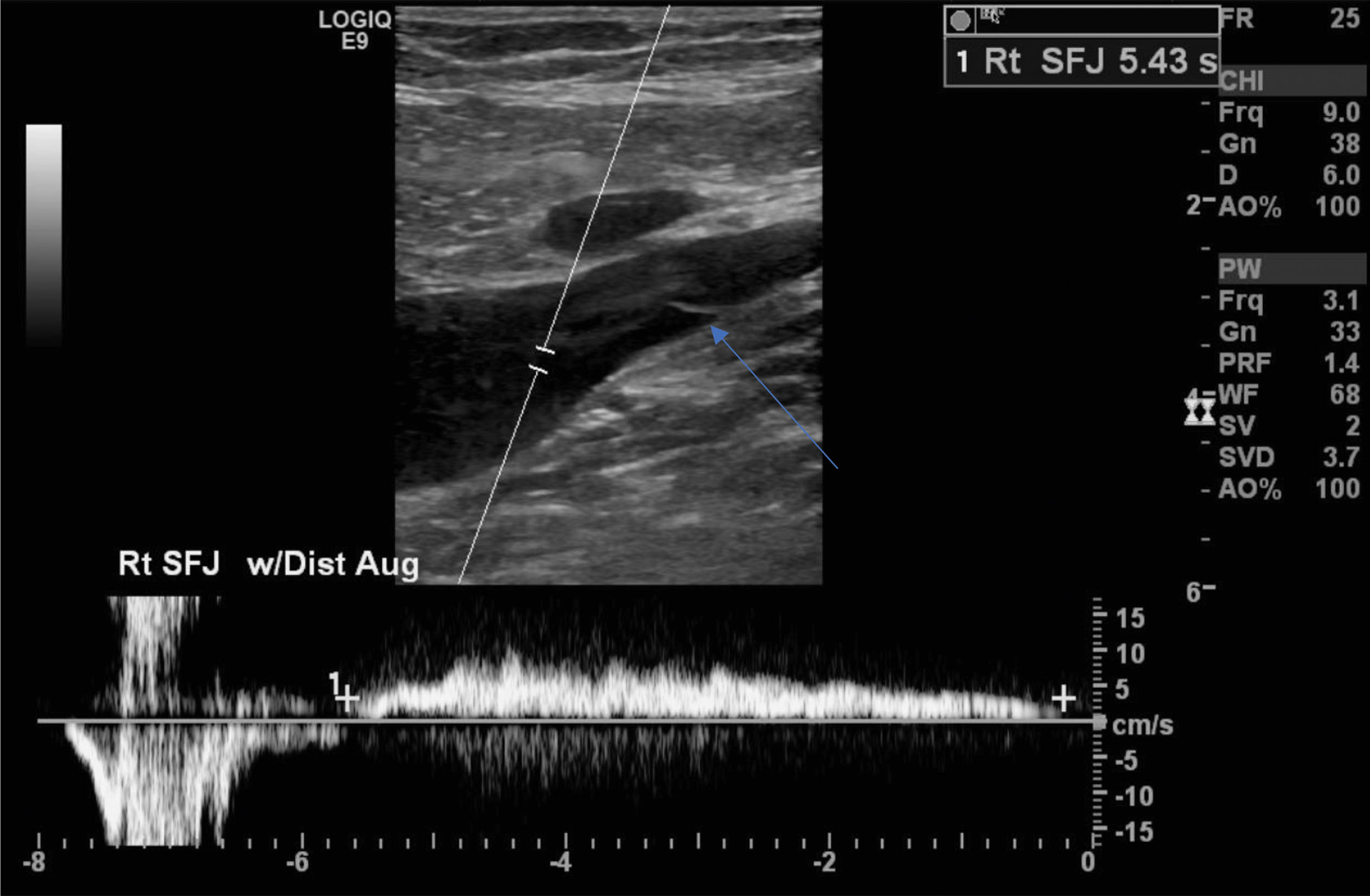 An ultrasound view of the saphenofemoral junction with waveform tracing and labeled structures. The ultrasound view with imaging on the upper half and spectral Doppler tracing on the lower half. The upper section displays a longitudinal view of the saphenofemoral junction labeled S F J. A solid arrow points to a specific point along the vessel wall. The lower section shows a spectral waveform pattern with vertical and horizontal axes, and scale markings on both sides. Measurement lines and trace curves appear along the graph, reflecting flow characteristics through the junction. The display includes standard scale markings and interface elements.