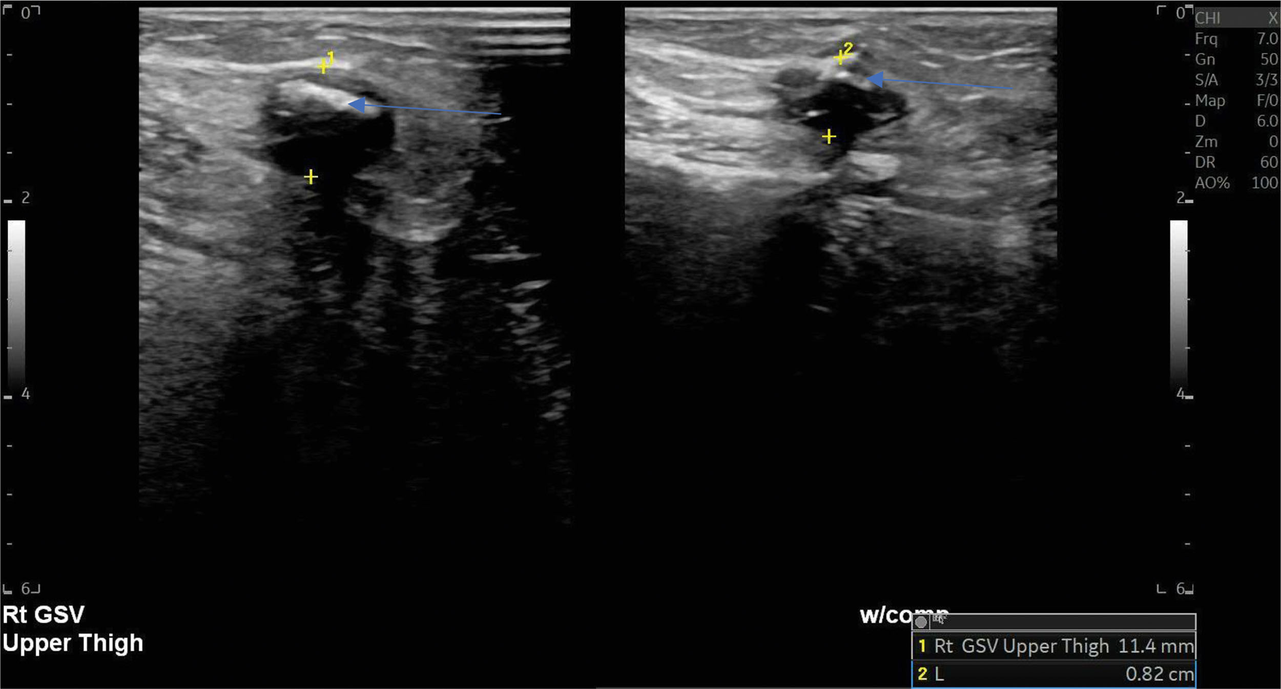 A panel includes an ultrasound view showing partial vein compressibility with a labeled great saphenous vein and a marked segment on a diagram. The panel includes two ultrasound panels and one adjacent anatomical diagram. The left section shows two ultrasound views of the great saphenous vein labeled G S V. Both panels show the vein in transverse view during different stages of compression. An arrow points to the vein wall in each panel. The right section shows a diagram of the lower limb with a line that marks the path of the vein. A short segment along the path appears highlighted with a darker line.