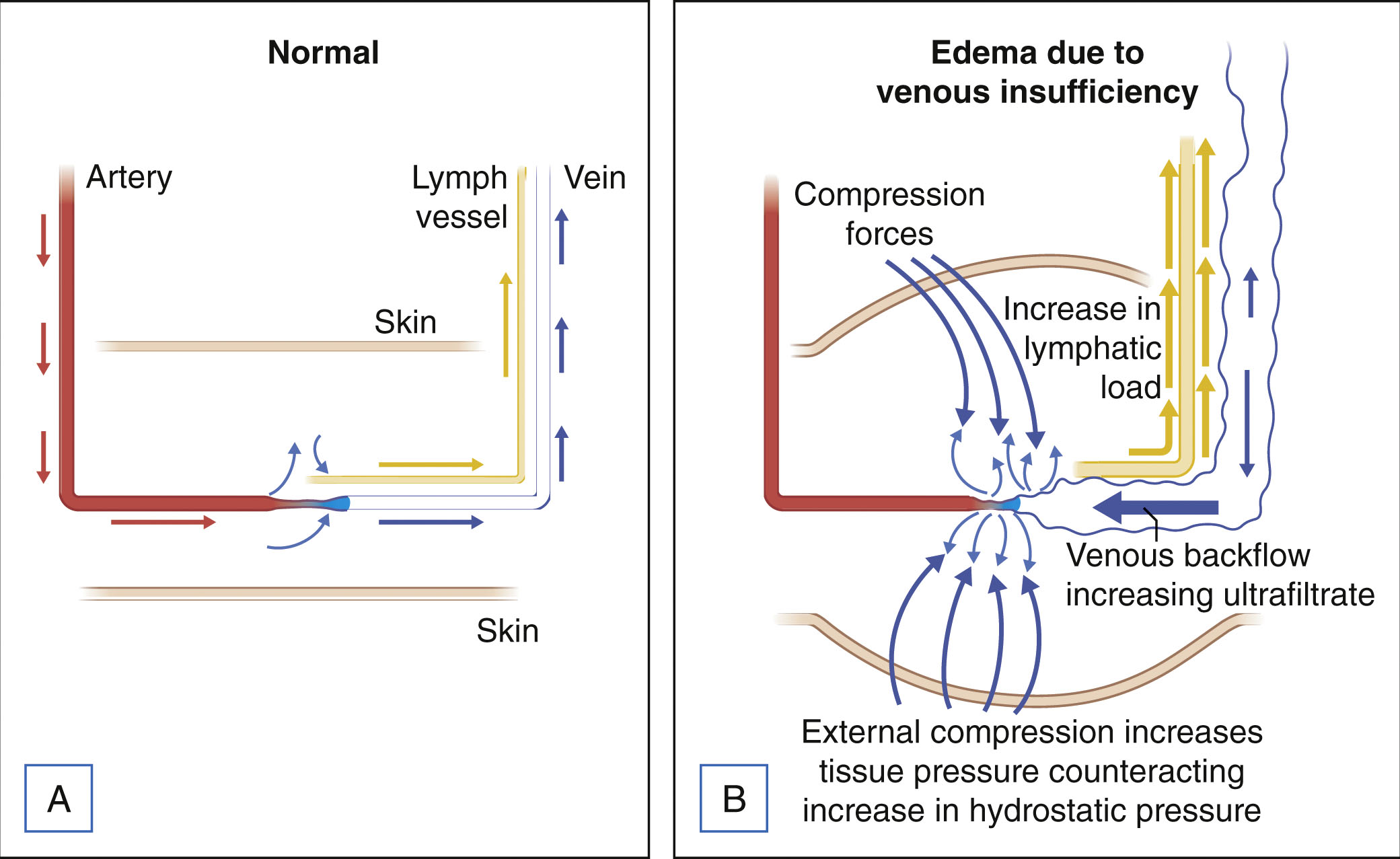 A two-panel layout compares normal circulation and edema due to venous insufficiency with labeled vessels, forces, and flow directions. The two-panel layout is labeled A and B. Panel A is labeled normal. It shows three vertical vessels labeled artery, lymph vessel, and vein, all extending downward toward a horizontal layer labeled skin. Arrows show fluid moving from the artery to the skin, then into the lymph vessel and vein. Panel B is labeled edema due to venous insufficiency. It includes the same structures with additional curved lines and arrows. A curved boundary is labeled compression force. Arrows point inward toward the vessels and skin. Text labels include an increase in lymphatic load, venous backflow, increasing ultrafiltrate, and external compression increases tissue pressure, counteracting the increase in hydrostatic pressure.