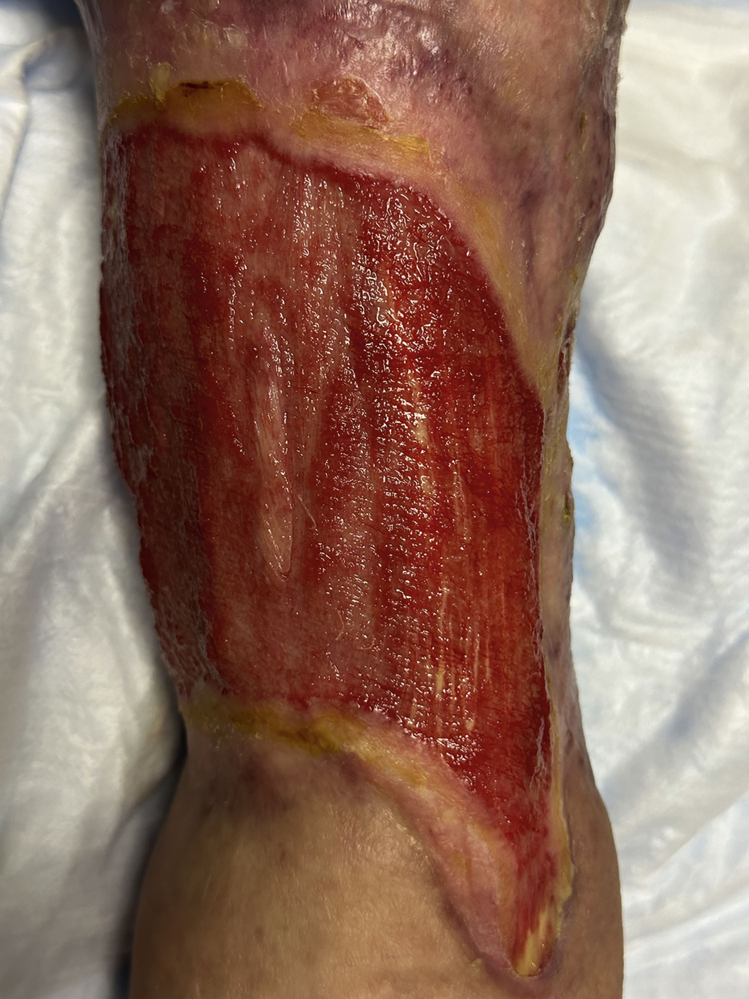 A lower leg shows an extensive ulcer with a raw surface, moist exposed tissue, yellowish edges, and surrounding discolored skin without scabs or coverings.