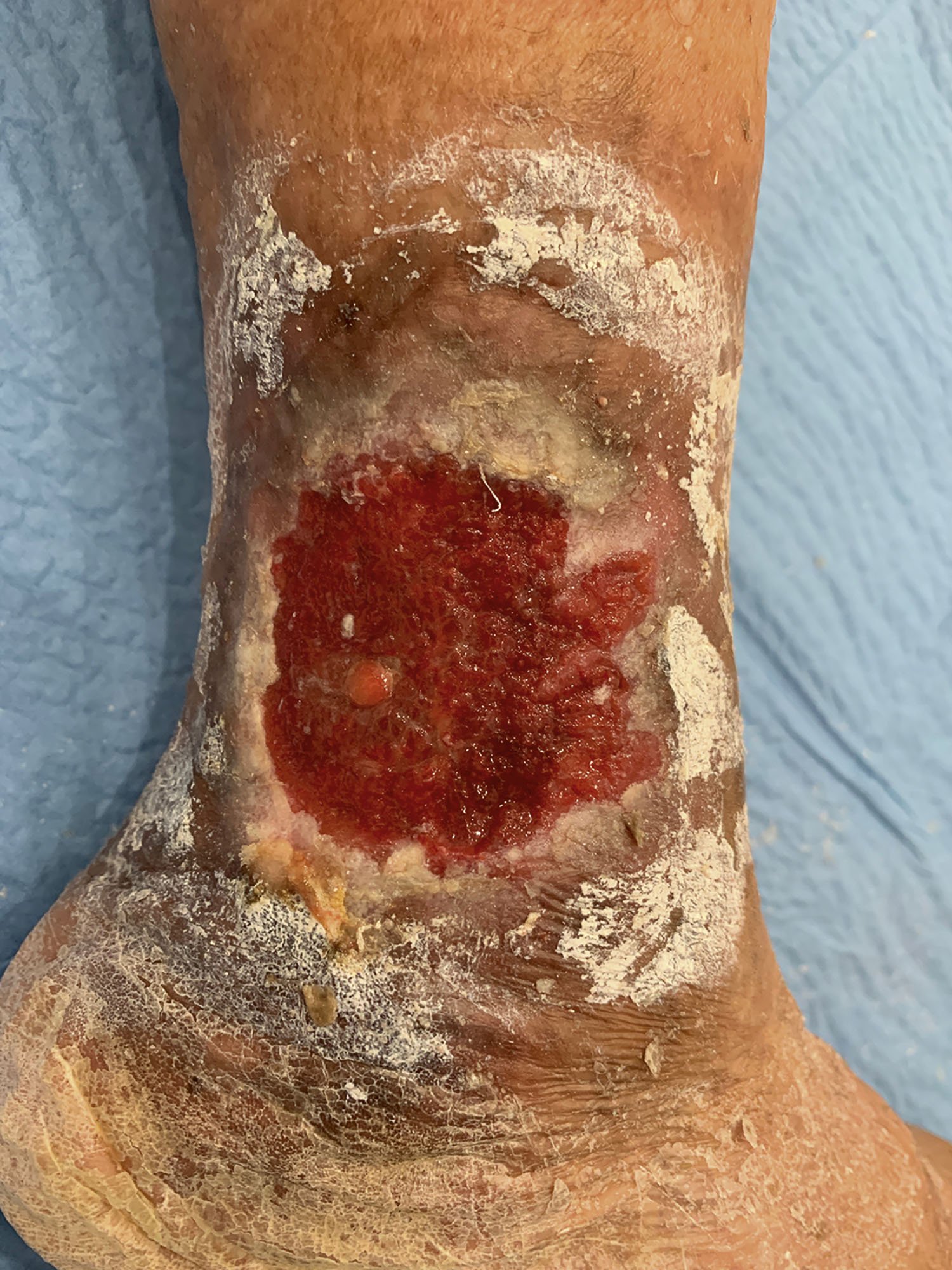 A right leg shows a large ulcer with an irregular, moist surface, surrounded by dry scaly skin and yellowish crust, extending toward the ankle with discolored skin around the edges.