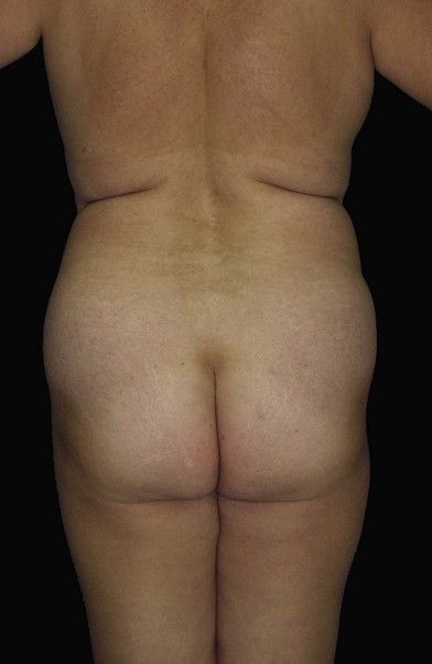 Buttock augmentation