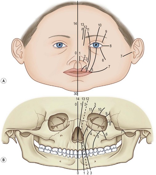 Craniofacial Clefts Plastic Surgery Key 