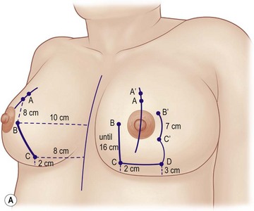 Mammaplasty with L-shaped scar