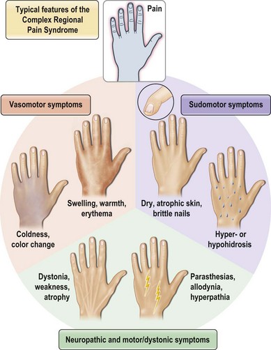 complex-regional-pain-syndrome-in-the-upper-extremity-plastic-surgery-key