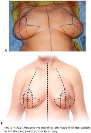 mammoplasty reduction surgery