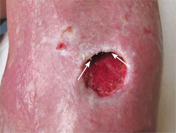 epithelial tissue wound