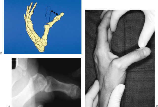 Ulnar Collatreal Ligament Injuries Skiers Thumb Plastic Surgery Key
